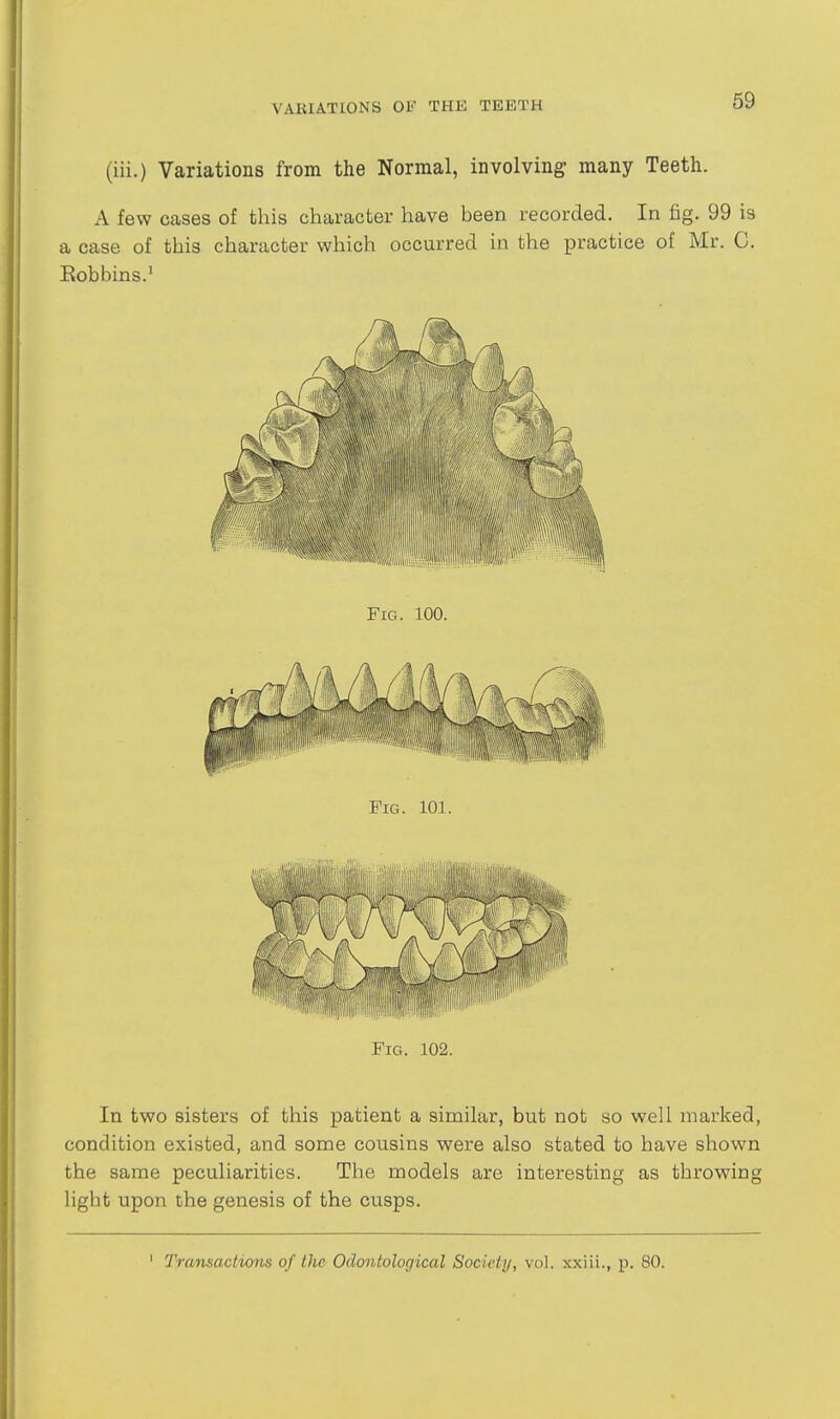 (iii.) Variations from the Normal, involving; many Teeth. A few cases of this character have heen recorded. In fig. 99 is a case of this character which occurred in the practice of Mr. C. Eobbins.' Fig. 102. In two sisters of this patient a similar, but not so well marked, condition existed, and some cousins were also stated to have shown the same peculiarities. The models are interesting as throwing light upon the genesis of the cusps.