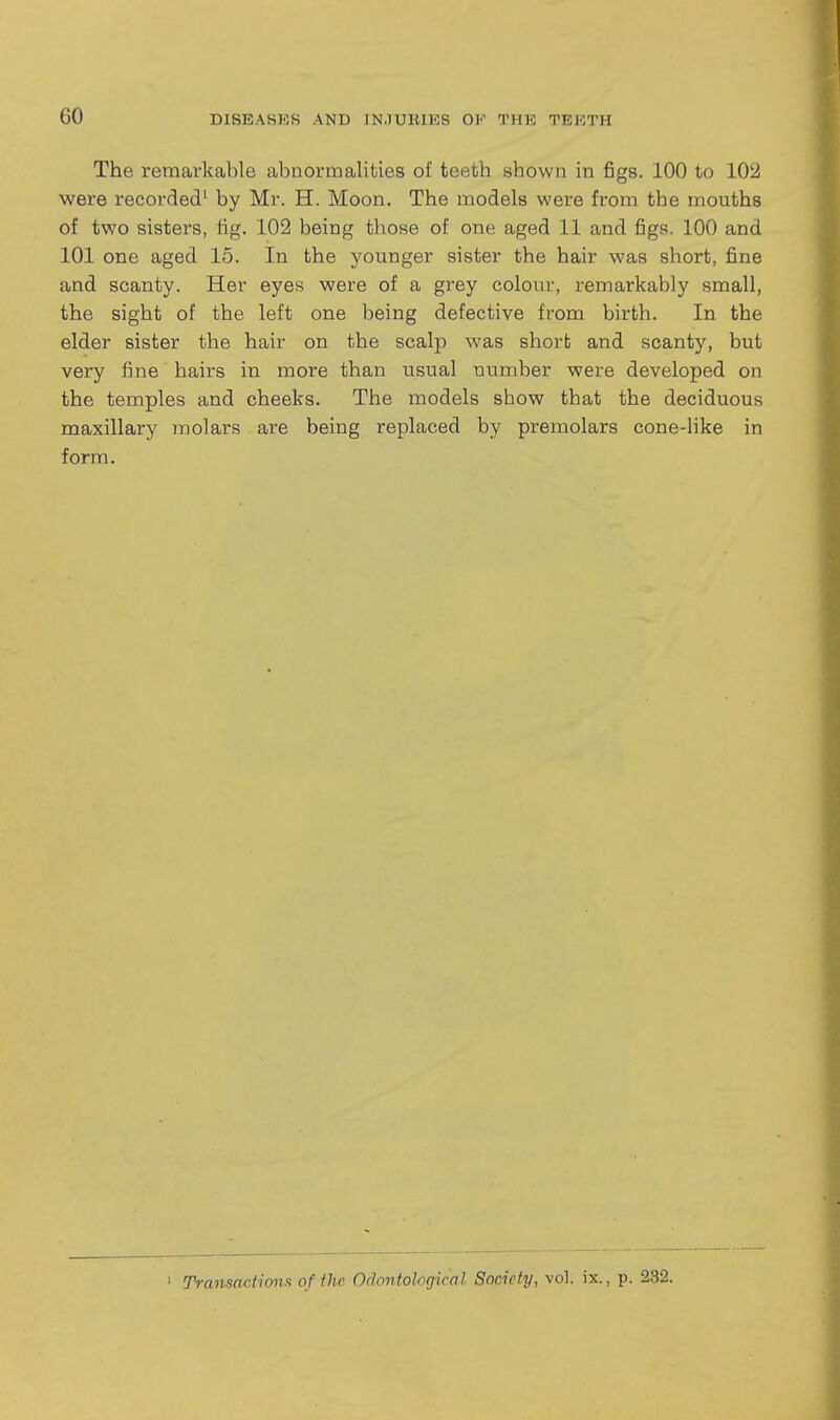 The remarkable abnormalities of teefch shown in figs. 100 to 102 were recorded^ by Mr. H. Moon. The models were from the mouths of two sisters, fig. 102 being those of one aged 11 and figs. 100 and 101 one aged 15. In the younger sister the hair was short, fine and scanty. Her eyes were of a grey colour, remarkably small, the sight of the left one being defective from birth. In the elder sister the hair on the scalp was short and scanty, but very fine hairs in more than usual number were developed on the temples and cheeks. The inodels show that the deciduous maxillary molars are being replaced by premolars cone-like in form.