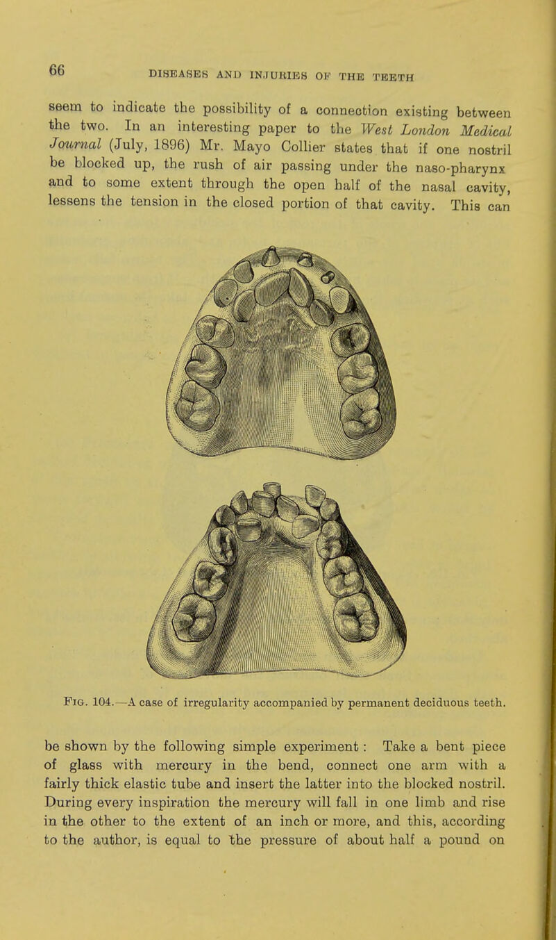 seem to indicate the possibility of a connection existing between the two. In an interesting paper to the West London Medical Jotmial (July, 1896) Mr. Mayo Colher states that if one nostril be blocked up, the rush of air passing under the naso-pharynx and to some extent through the open half of the nasal cavity, lessens the tension in the closed portion of that cavity. This can Fig. 104.—A case of irregularity accompanied by permanent deciduous teeth. be shown by the following simple experiment: Take a bent piece of glass with mercury in the bend, connect one arm with a fairly thick elastic tube and insert the latter into the blocked nostril. During every inspiration the mercury will fall in one limb and rise in the other to the extent of an inch or more, and this, according to the author, is equal to the pressure of about half a pound on