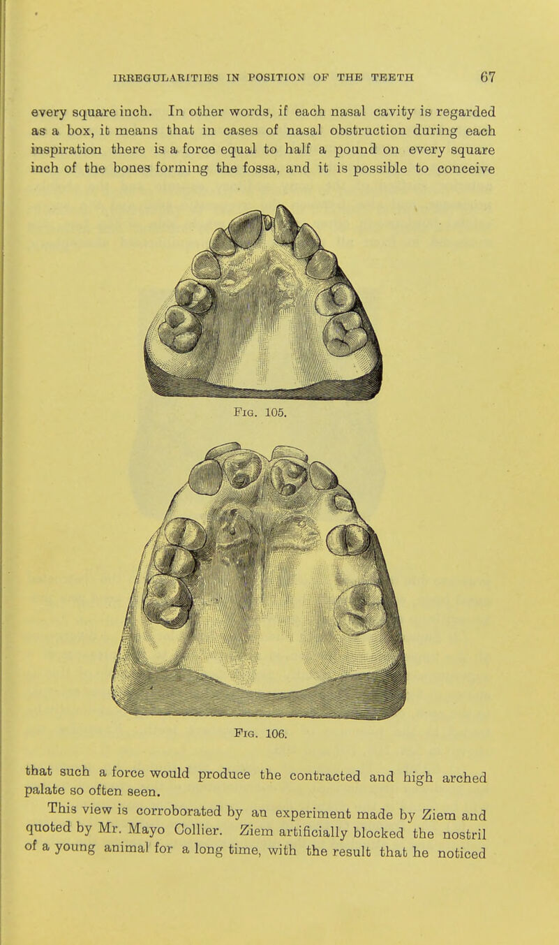 every square inch. In other words, if each nasal cavity is regarded as a box, it means that in cases of nasal obstruction during each inspiration there is a force equal to half a pound on every square inch of the bones forming the fossa, and it is possible to conceive Fig. 105. Fig. 106. that such a force would produce the contracted and high arched palate so often seen. This view is corroborated by an experiment made by Ziem and quoted by Mr. Mayo Collier. Ziem artificially blocked the nostril of a young animal for a long time, with the result that he noticed