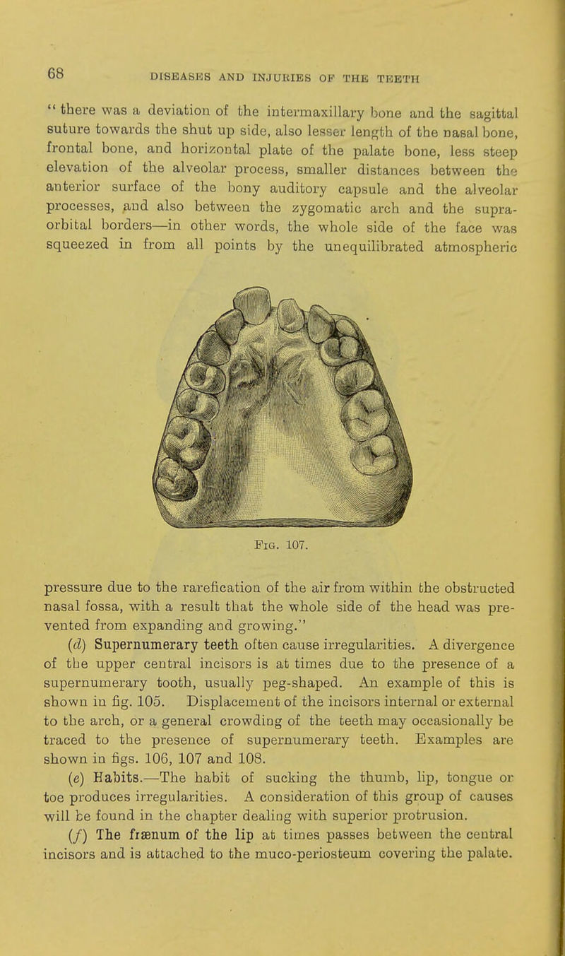  there was a deviation of the intermaxillary bone and the sagittal suture towards the shut up side, also lesser length of the nasal bone, frontal bone, and horizontal plate of the palate bone, less steep elevation of the alveolar process, smaller distances between the anterior surface of the l)ony auditory capsule and the alveolar processes, and also between the zygomatic arch and the supra- orbital borders—in other words, the whole side of the face was squeezed in from all points by the unequilibrated atmospheric pressure due to the rarefication of the air from within the obstructed nasal fossa, with a result that the whole side of the head was pre- vented from expanding and growing. (d) Supernumerary teeth often cause irregularities. A divergence of the upper central incisors is at times due to the presence of a supernumerary tooth, usually peg-shaped. An example of this is shown in fig. 105. Displacement of the incisors internal or external to the arch, or a general crowding of the teeth may occasionally be traced to the presence of supernumerary teeth. Examples are shown in figs. 106, 107 and 108. (e) Habits.—The habit of sucking the thumb, lip, tongue or toe produces irregularities. A consideration of this group of causes will be found in the chapter dealing with superior protrusion. (/) The fisenum of the lip at times passes between the central incisors and is attached to the muco-periosteum covering the palate.