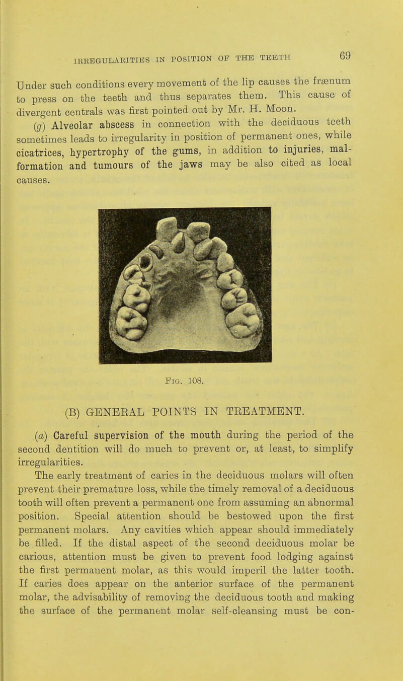 Under such conditions every movement of the lip causes the fraenum to press on the teeth and thus separates them. This cause of divergent centrals was first pointed out by Mr. H. Moon. {g) Alveolar abscess in connection with the deciduous teeth sometimes leads to irregularity in position of permanent ones, while cicatrices, hypertrophy of the gums, in addition to injuries, mal- formation and tumours of the jaws may be also cited as local causes. Fig. 108. (B) GENERAL POINTS IN TREATMENT. [a) Careful supervision of the mouth during the period of the second dentition will do much to prevent or, at least, to simplify irregularities. The early treatment of caries in the deciduous molars will often prevent their premature loss, while the timely removal of a deciduous tooth will often prevent a permanent one from assuming an abnormal position. Special attention should be bestowed upon the first permanent molars. Any cavities which appear should immediately be filled. If the distal aspect of the second deciduous molar be carious, attention must be given to prevent food lodging against the first permanent molar, as this would imperil the latter tooth. If caries does appear on the anterior surface of the permanent molar, the advisability of removing the deciduous tooth and making the surface of the permanent molar self-cleansing must be con-