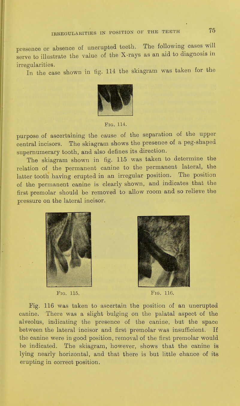 presence or absence of unerupted teeth. The following cases will serve to illustrate the value of the X-rays as an aid to diagnosis in irregularities. In the case shown in tig. 114 the skiagram was taken for the Fig. 114. purpose of ascertaining the cause of the separation of the upper central incisors. The skiagram shows the presence of a peg-shaped supernumerary tooth, and also defines its direction. The skiagram shown in fig. 115 was taken to determine the relation of the permanent canine to the permanent lateral, the latter tooth having erupted in an irregular position. The position of the permanent canine is clearly shown, and indicates that the first premolar should be removed to allow room and so relieve the pressure on the lateral incisor. Fig. 115. Fig. 116. Fig. 116 was taken to ascertain the position of an unerupted canine. There was a slight bulging on the palatal aspect of the alveolus, indicating the presence of the canine, but the space between the lateral incisor and first premolar was insufljcient. If the canine were in good position, removal of the first premolar would be indicated. The skiagram, however, shows that the canine is lying nearly horizontal, and that there is but little chance of its erupting in correct position.