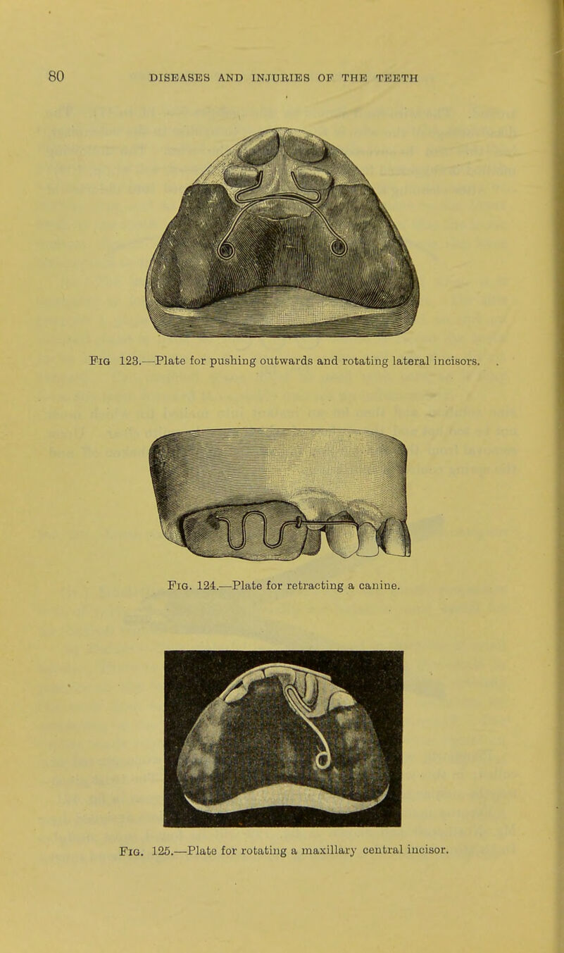 Fig. 125.—Plate for rotating a maxillary central iucisor.