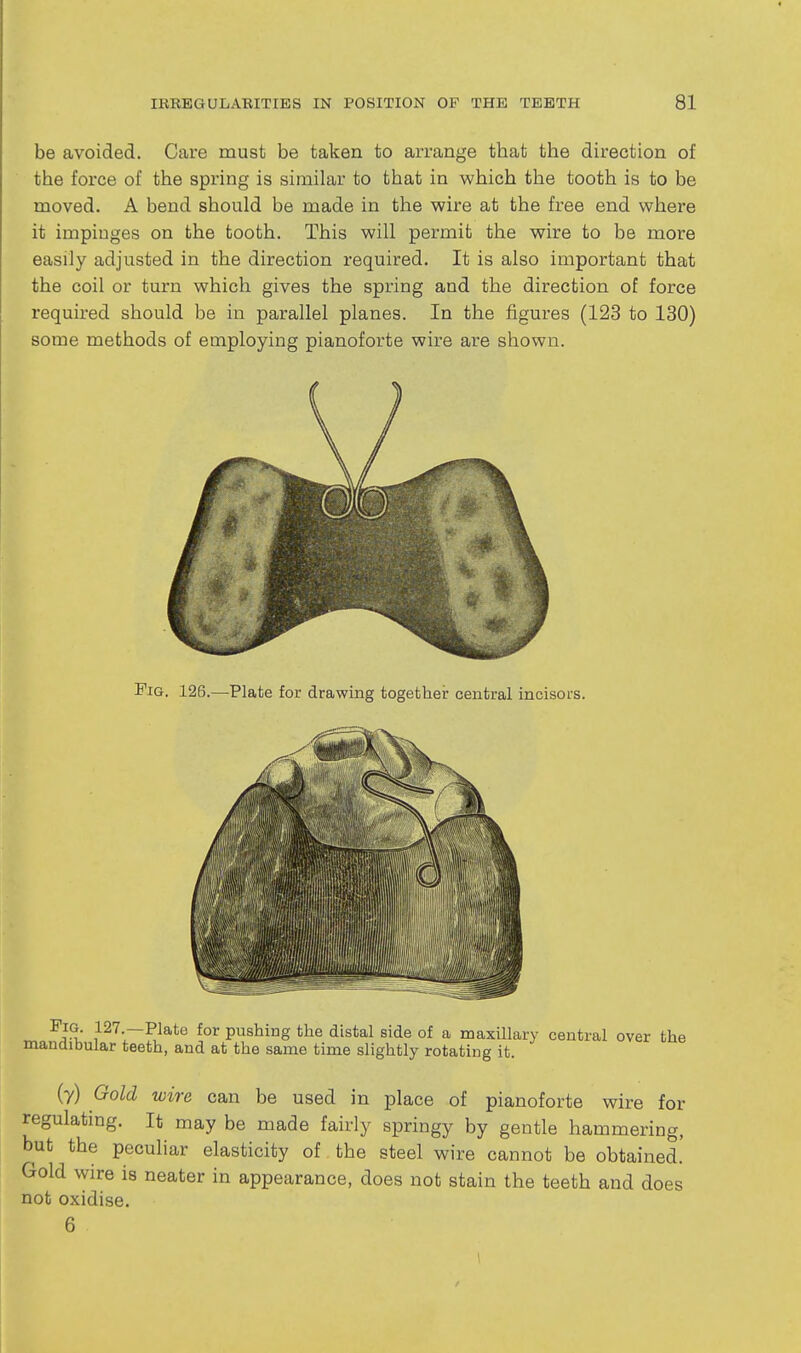 be avoided. Care must be taken to arrange that the direction of the force of the spring is similar to that in which the tooth is to be moved. A bend should be made in the wire at the free end where it impinges on the tooth. This will permit the wire to be more easily adjusted in the direction required. It is also important that the coil or turn which gives the spring and the direction of force required should be in parallel planes. In the figures (123 to 130) some methods of employing pianoforte wire are shown. Fig. 126.—Plate for drawing togethei: central incisors. Pig. 127.—Plate for pushing the distal side of a maxillary central over the mandibular teeth, and at the same time slightly rotating it. (y) Gold wire can be used in place of pianoforte wire for regulatmg. It may be made fairly springy by gentle hammering, but the peculiar elasticity of the steel wire cannot be obtained.' Gold wire is neater in appearance, does not stain the teeth and does not oxidise. 6