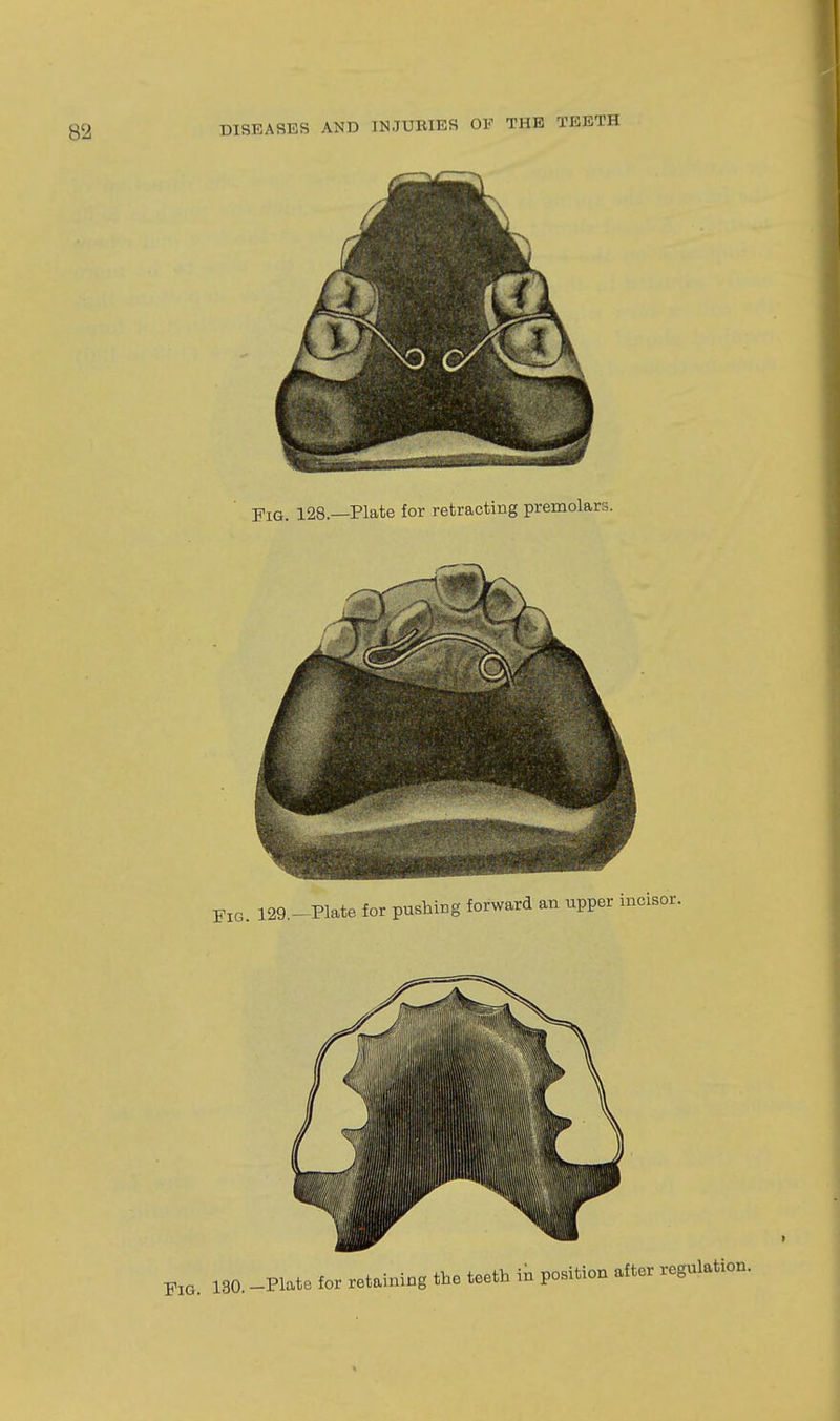 Fig. 128.—Plate for retracting premolars. , _Plate for retaining the teeth in position after regulation.