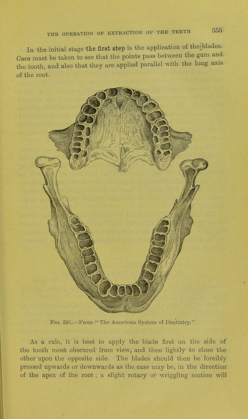 In the initial stage the first step is the application of the-blades. Care must be taken to see that the points pass bet^yeen the gum and the tooth, and also that they are applied parallel with the long axis of the root. Pig. 591.—From The American System of Dentistry. As a rule, ib is best to apply the blade first on the side of the tooth most obscured from view, and then lightly to close the other upon the opposite side. The blades should then be forcibly pressed upwards or downwards as the case may be, in the direction of the apex of the root; a slight rotary or wriggling motion will