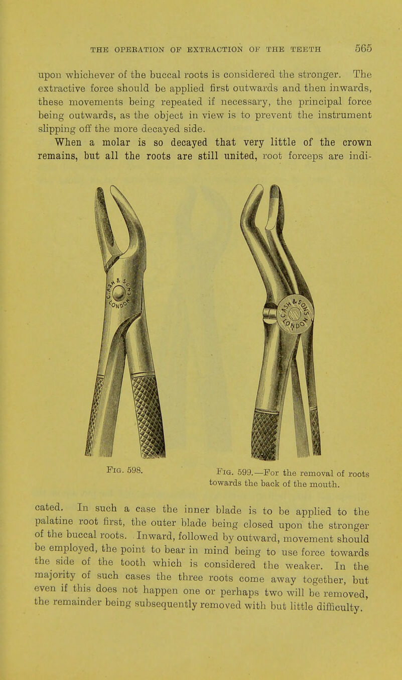 upon whichever of the buccal roots is considered the stronger. The extractive force should be applied first outwards and then inwards, these movements being repeated if necessary, the principal force being outwards, as the object in view is to prevent the instrument slipping off the more decayed side. When a molar is so decayed that very little of the crown remains, but all the roots are still united, root forceps are indi- FiG. 598. Fig. 599.—For the removal of roots towards the hack of the mouth. cated. In such a case the inner blade is to be applied to the palatine root first, the outer lilade being closed upon the stronger of the buccal roots. Inward, followed by outward, movement should be employed, the point to bear in mind being to use force towards the^ side of the tooth which is considered the weaker. In the majority of such cases the three roots come away together, but even if this does not happen one or perhaps two will be removed, the remamder being subsequently removed with but little difficulty.