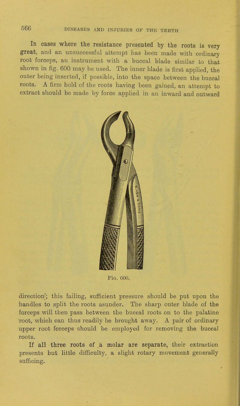 In cases where the resistance presented by the roots is very great, and an unsuccessful attempt has been made with ordinary root forceps, an instrument with a buccal blade similar to that shown in fig. 600 may be used. The inner blade is first apphed, the outer being inserted, if possible, into the space between the buccal roots. A firm hold of the roots having been gained, an attempt to extract should be made by force applied in an inward and outward FiG. 600. direction;; this failing, sufficient pressure should be put upon the handles to spht the roots asunder. The sharp outer blade of the forceps will then pass between the buccal roots on to the palatine root, which can thus readily be brought away. A pair of ordinai'y upper root forceps should be employed for removing the buccal roots. If all three roots of _a molar are separate, their extraction presents but little difficulty, a slight rotary movement generally sufficing.