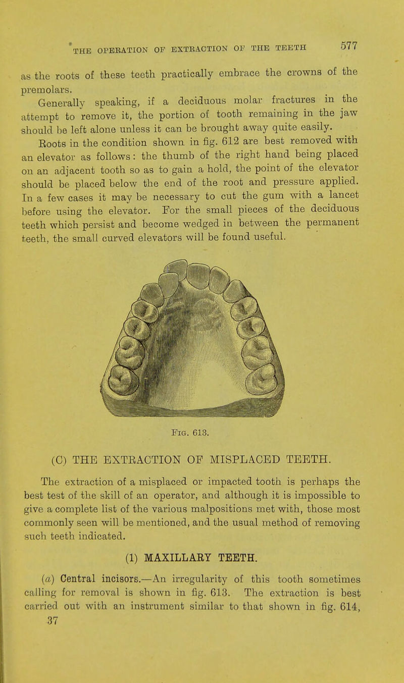 as the roots of these teeth practically embrace the crowns of the premolars. Generally speaking, if a deciduous molar fractures in the attempt to remove it, the portion of tooth remaining in the jaw should he left alone unless it can be brought away quite easily. Roots in the condition shown in fig. 612 are best removed with an elevator as follows: the thumb of the right hand being placed on an adjacent tooth so as to gain a hold, the point of the elevator should be placed below the end of the root and pressure applied. In a few cases it may be necessary to cut the gum with a lancet l)efore using the elevator. For the small pieces of the deciduous teeth which persist and become wedged in between the permanent teeth, the small curved elevators will be found useful. Fig. 613. (C) THE EXTEACTION OF MISPLACED TEETH. The extraction of a misplaced or impacted tooth is perhaps the best test of the skill of an operator, and although it is impossible to give a complete list of the various malpositions met with, those most commonly seen will be mentioned, and the usual method of removing such teeth indicated. (1) MAXILLARY TEETH. {a) Central incisors.—An irregularity of this tooth sometimes calling for removal is shown in fig. 613. The extraction is best carried out with an instrument similar to that shown in fig. 614, 37