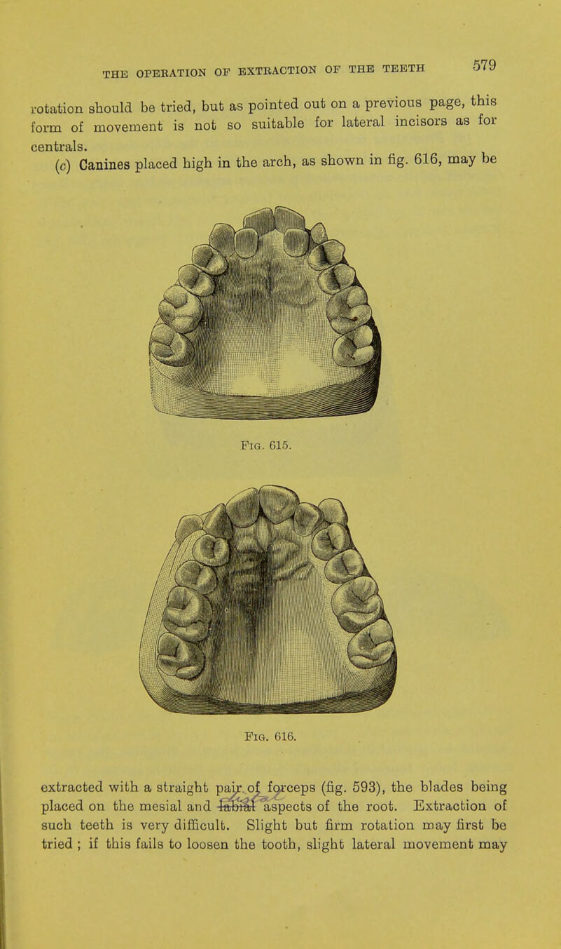 rotation should be tried, but as pointed out on a previous page, this form of movement is not so suitable for lateral incisors as for centrals. (c) Canines placed high in the arch, as shown in fig. 616, may be Fig. 615. Fig. 616. extracted with a straight paur^offorceps (fig. 593), the blades being placed on the mesial and ■^^rfaspects of the root. Extraction of such teeth is very difficult. Slight but firm rotation may first be tried ; if this fails to loosen the tooth, slight lateral movement may