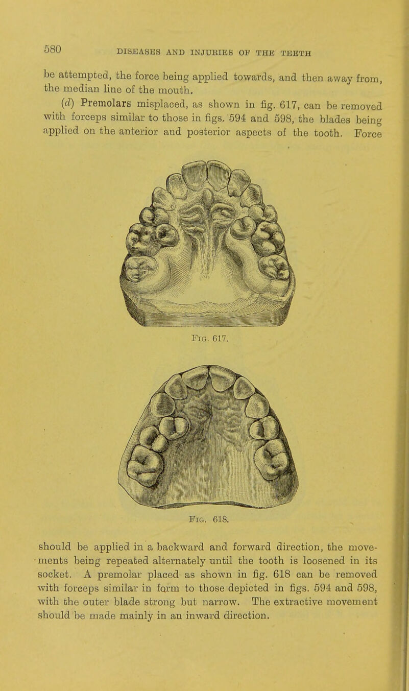 be attempted, the force being applied towards, and then away from, the median hne of the mouth. (d) Premolars misplaced, as shown in fig. 617, can be removed with forceps similar to those in figs, 594 and 598, the blades being applied on the anterior and posterior aspects of the tooth. Force Fig. 618. should be applied in a backward and forward direction, the move- ■ ments being repeated alternately until the tooth is loosened in its socket. A premolar placed as shown in fig. 618 can be removed with forceps similar in form to those depicted in figs. 594 and 598, with the outer blade strong but narrow. The extractive movement should be made mainly in an inward direction.