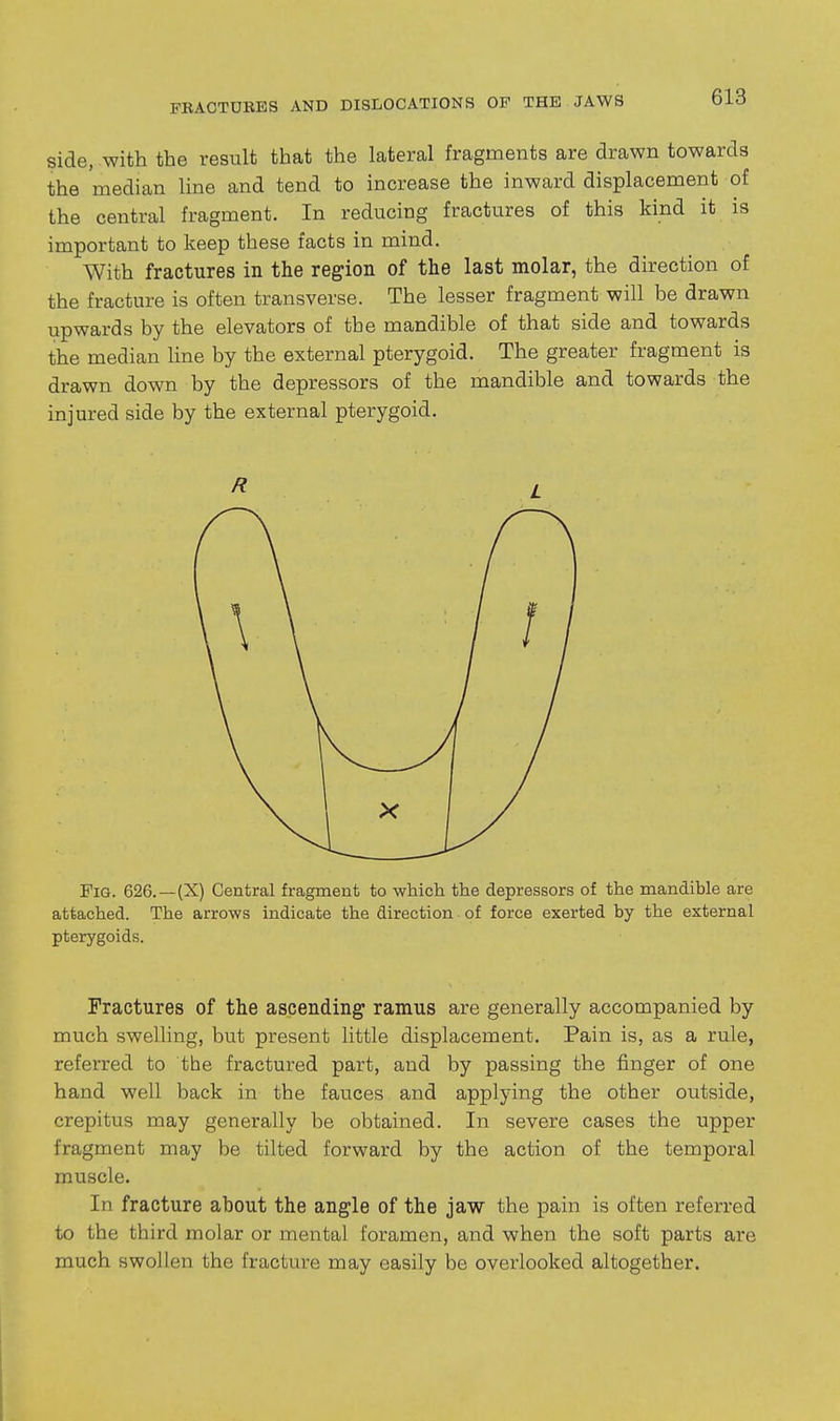 side, with the result that the lateral fragments are drawn towards the median line and tend to increase the inward displacement of the central fragment. In reducing fractures of this kind it is important to keep these facts in mind. With fractures in the region of the last molar, the direction of the fracture is often transverse. The lesser fragment will be drawn upwards by the elevators of the mandible of that side and towards the median line by the external pterygoid. The greater fragment is drawn down by the depressors of the mandible and towards the injured side by the external pterygoid. Fig. 626.—(X) Central fragment to which the depressors of the mandible are attached. The arrows indicate the direction of force exerted by the external pterygoids. Fractures of the ascending ramus are generally accompanied by much swelling, but present little displacement. Pain is, as a rule, referred to the fractured part, and by passing the finger of one hand well back in the fauces and applying the other outside, crepitus may generally be obtained. In severe cases the upper fragment may be tilted forward by the action of the temporal muscle. In fracture about the angle of the jaw the pain is often referred to the third molar or mental foramen, and when the soft parts are much swollen the fracture may easily be overlooked altogether. R L