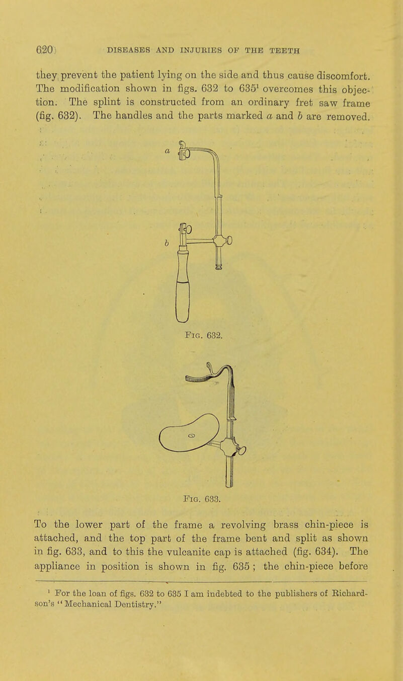 tiaey, prevent the patient lying on the side and thus cause discomfort. The modification shown in figs. 632 to 635^ overcomes this objec- tion. The spHnt is constructed from an ordinary fret saw frame (fig. 632). The handles and the parts marked a and h are removed. Fig. 632. I Fig. 633. To the lower part of the frame a revolving brass chin-piece is attached, and the top part of the frame bent and split as shown in fig. 633, and to this the vulcanite cap is attached (fig. 634). The appliance in position is shown in fig. 635 ; the chin-piece before ' For the loan of jBgs. 632 to 635 I am indebted to the publishers of Richard- son's Mechanical Dentistry.