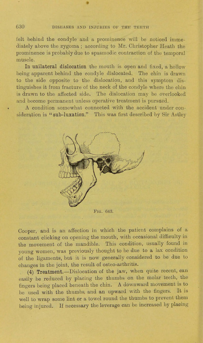 D 630 DISEASES AND INJUllIKS 01-' THK TEETH felt behind the condyle and a prominence will be noticed imme- diately above the zygoma ; according to Mr. Christopher Heath the prominence is probably due to spasmodic contraction of the temporal muscle- In unilateral dislocation the mouth is open and fixed, a hollow being apparent behind the condyle dislocated. The chin is drawn to the side opposite to the dislocation, and this symptom dis- tinguishes it from fracture of the neck of the condyle where the chin is drawn to the affected side. The dislocation may be overlooked and become permanent unless operative treatment is pursued. A condition somewhat connected with the accident under con- sideration is  sub-luxation. This was first described by Sir Astley Fig. 643. Cooper, and is an affection in which the patient complains of a constant clicking on opening the mouth, with occasional difficulty in the movement of the mandible. This condition, usually found in young women, was previously thought to be due to a lax condition of the hgaments, but it is now generally considered to be due to changes in the joint, the result of osteo-arthritis. (4) Treatment.—Dislocation of the jaw, when quite recent, can easily be reduced by placing the thumbs on the molar teeth, the fingers being placed beneath the chin. A downward movement is to be used with the thumba and an upward with the fingers. It is well to wrap some lint or a towel round the thumbs to prevent them being injured. If necessary the leverage can be increased by placing
