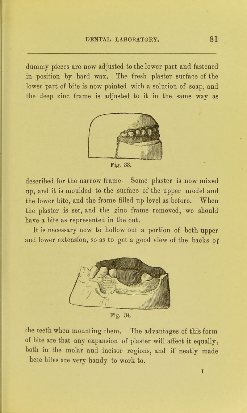 dummy pieces are now adjusted to the lower part and fastened in position by hard wax. The fresh plaster surface of the lower part of bite is now painted with a solution of soap, and the deep zinc frame is adjusted to it in the same way as Fig. 33. described for the narrow frame. Some plaster is now mixed up, and it is moulded to the surface of the upper model and the lower bite, and the frame filled up level as before. When the plaster is set, and the zinc frame removed, we should have a bite as represented in the cut. It is necessary now to hollow out a portion of both upper and lower extension, so as to get a good view of the backs of Fig. 34. the teeth when mounting them. The advantages of this form of bite are that any expansion of plaster will affect it equally, both in the molar and incisor regions, and if neatly made he£e bites are very handy to work to. I