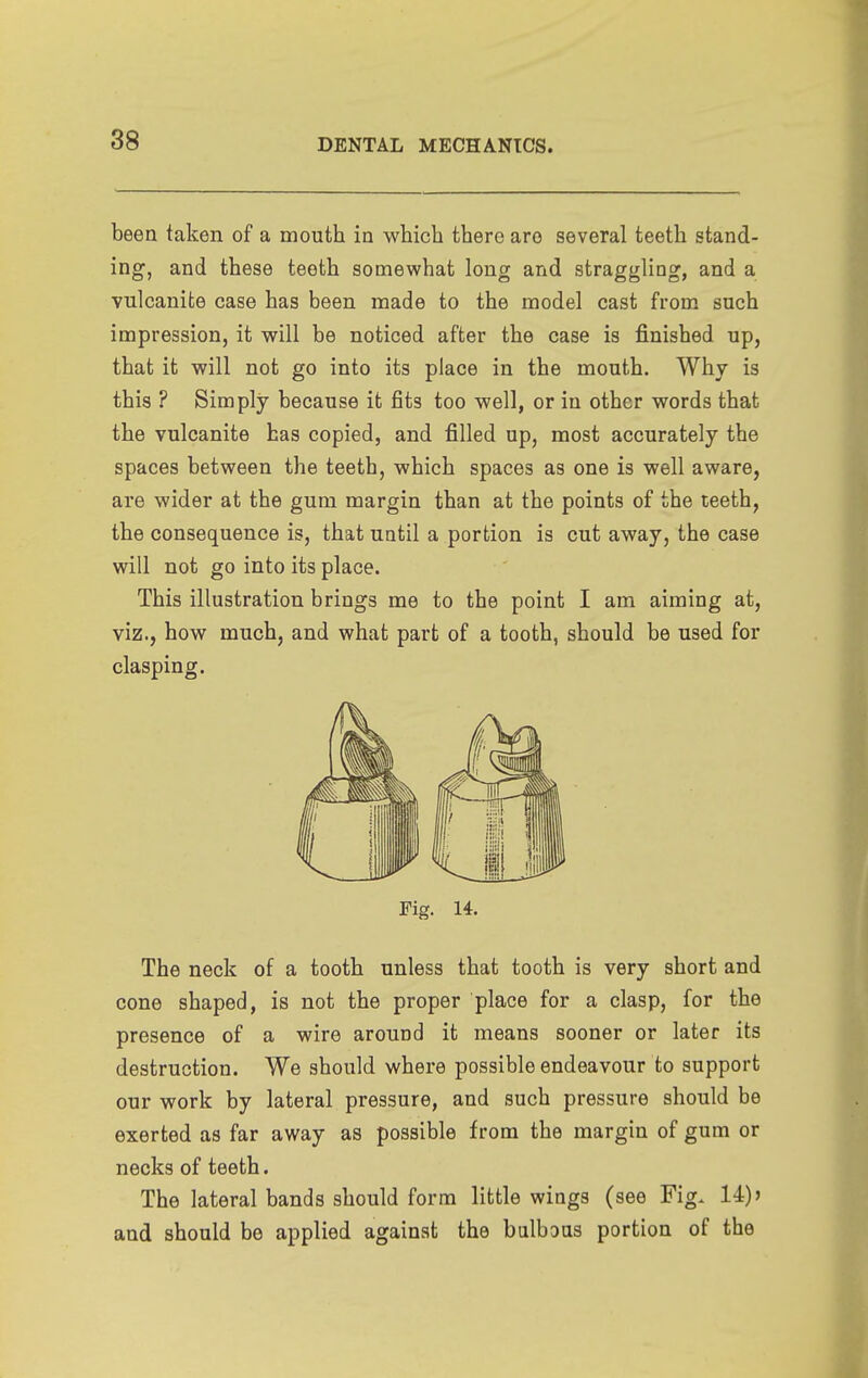 been taken of a mouth in which there are several teeth stand- ing, and these teeth somewhat long and straggling, and a vulcanite case has been made to the model cast from such impression, it will be noticed after the case is finished up, that it will not go into its place in the mouth. Why is this ? Simply because it fits too well, or in other words that the vulcanite has copied, and filled up, most accurately the spaces between the teeth, which spaces as one is well aware, are wider at the gum margin than at the points of the teeth, the consequence is, that until a portion is cut away, the case will not go into its place. This illustration brings me to the point I am aiming at, viz., how much, and what part of a tooth, should be used for clasping. Fig. 14. The neck of a tooth unless that tooth is very short and cone shaped, is not the proper place for a clasp, for the presence of a wire around it means sooner or later its destruction. We should where possible endeavour to support our work by lateral pressure, and such pressure should be exerted as far away as possible from the margin of gum or necks of teeth. The lateral bands should form little wings (see Fig. 14) j and should be applied against the balbaus portion of the