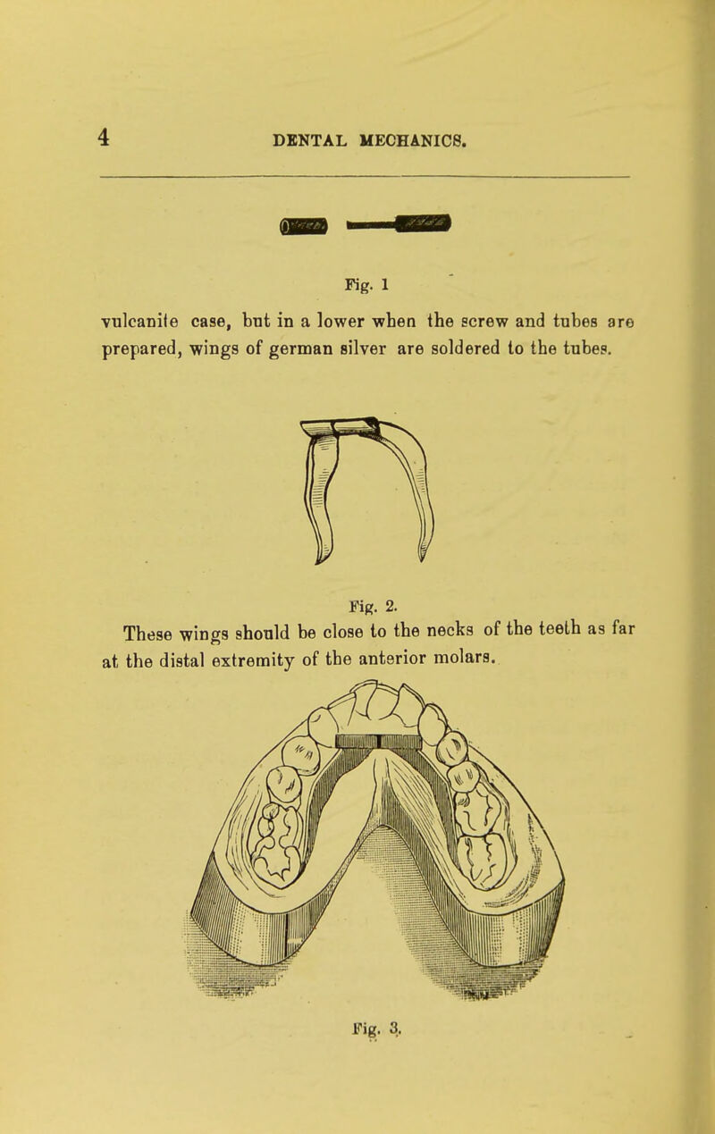 Fig. 1 vnlcanife case, but in a lower when the screw and tubes are prepared, wings of german silver are soldered to the tubes. Fif?. 2. These wings should be close to the necks of the teeth as far at the distal extremity of the anterior molars. Fig. 3,