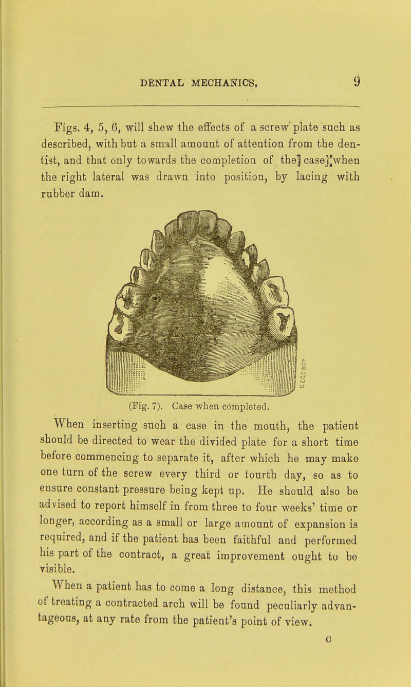Figs. 4, 5, 6, will shew the effects of a screw plate such as described, with but a small amount of attention from the den- list, and that only towards the completion of _ the] casej'when the right lateral was drawn into position, by lacing with rubber dam. (Fig. 7). Case when completed. When inserting such a case in the mouth, the patient should be directed to wear the divided plate for a short time before commencing to separate it, after which he may make one turn of the screw every third or fourth day, so as to ensure constant pressure being kept up. He should also be advised to report himself in from three to four weeks' time or longer, according as a small or large amount of expansion is required, and if the patient has been faithful and performed his part of the contract, a great improvement ought to be visible. When a patient has to come a long distance, this method of treating a contracted arch will be found peculiarly advan- tageous, at any rate from the patient's point of view.