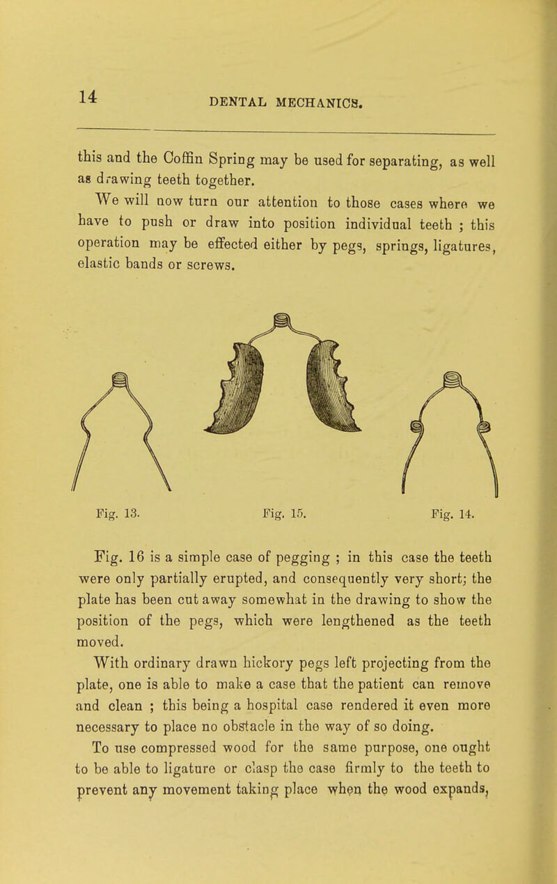 DENTAL MECHANICS. this and the Coffin Spring may be used for separating, as well as drawing teeth together. We will now turn our attention to those cases where we have to push or draw into position individual teeth ; this operation may be effected either by pegs, springs, ligatures, elastic bands or screws. Fig. 16 is a simple case of pegging ; in this case the teeth were only partially erupted, and consequently very short; the plate has been cutaway somewhat in the drawing to show the position of the pegs, which were lengthened as the teeth moved. With ordinary drawn hickory pegs left projecting from the plate, one is able to make a case that the patient can remove and clean ; this being a hospital case rendered it even more necessary to place no obstacle in the way of so doing. To use compressed wood for the same purpose, one ought to be able to ligature or clasp the case firmly to the teeth to prevent aJij movement taking place wh^n the wood expands.