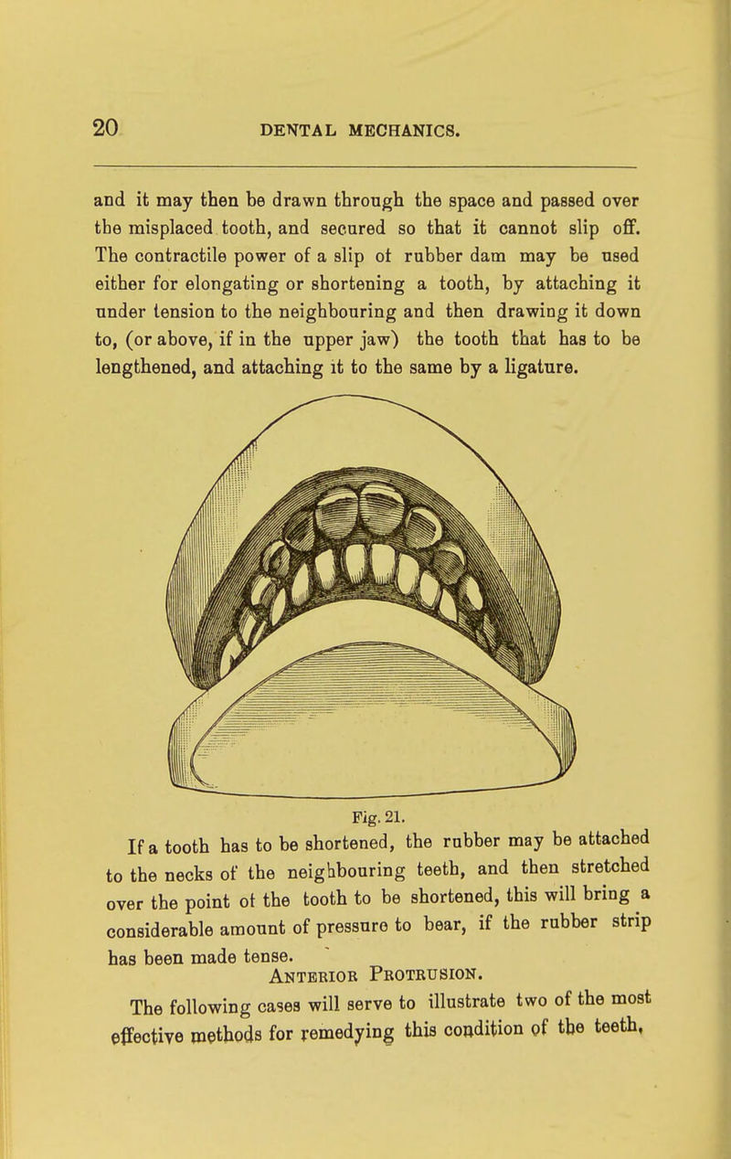 and it may then be drawn through the space and passed over the misplaced tooth, and secured so that it cannot slip off. The contractile power of a slip ot rubber dam may be used either for elongating or shortening a tooth, by attaching it under tension to the neighbouring and then drawing it down to, (or above, if in the upper jaw) the tooth that has to be lengthened, and attaching it to the same by a ligature. Fig. 21. If a tooth has to be shortened, the rubber may be attached to the necks of the neighbouring teeth, and then stretched over the point ot the tooth to be shortened, this will bring a considerable amount of pressure to bear, if the rubber strip has been made tense. Anterior Protrusion. The following cases will serve to illustrate two of the most effective methods for remedying this condition of the teeth,