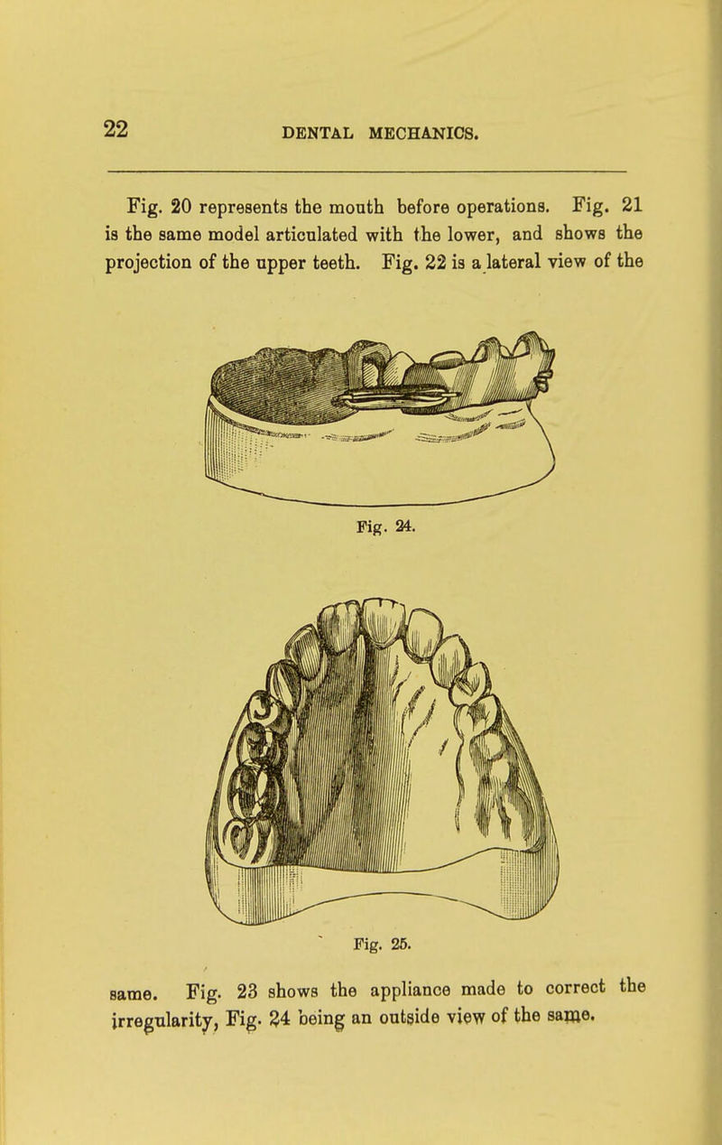 Fig. 20 represents the mouth before operations. Fig. 21 is the same model articulated with the lower, and shows the projection of the upper teeth. Fig. 22 is a lateral view of the Fig. 24. same. Fig. 23 shows the appliance made to correct the irregularity, Fig. ^4 bein^ an outgide view of the same.