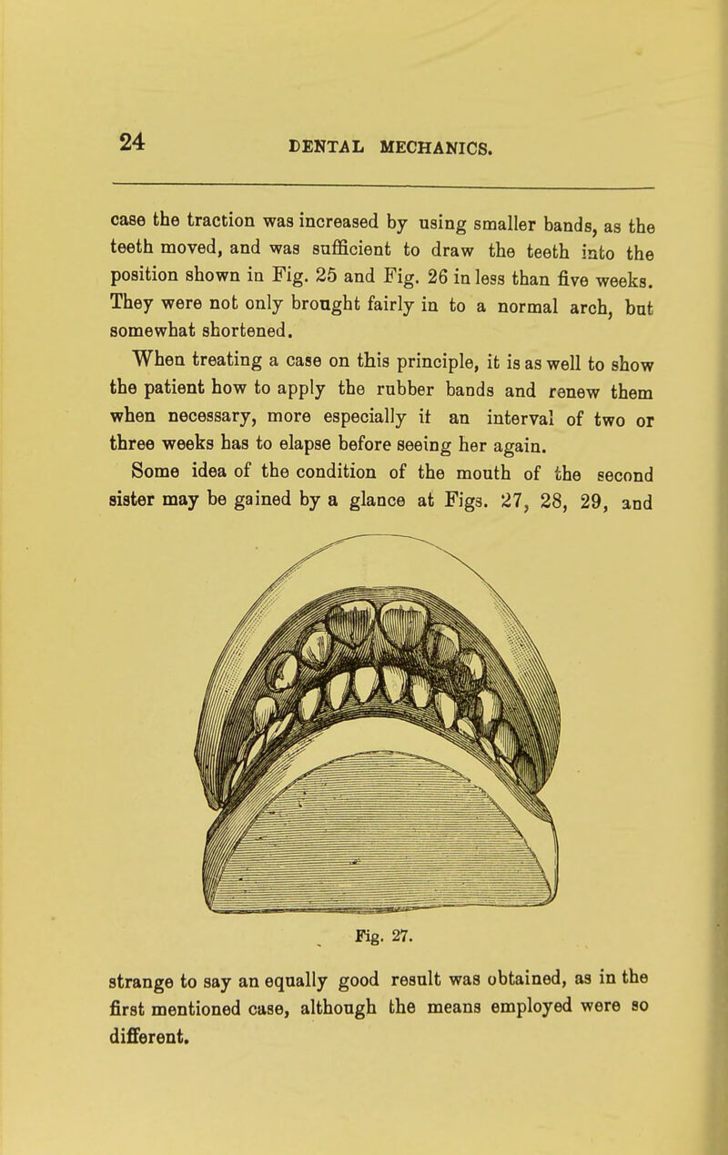 case the traction was increased by using smaller bands, as the teeth moved, and was sufficient to draw the teeth into the position shown in Fig. 25 and Fig. 26 in less than five weeks. They were not only brought fairly in to a normal arch, but somewhat shortened. When treating a case on this principle, it is as well to show the patient how to apply the rubber bands and renew them when necessary, more especially it an interval of two or three weeks has to elapse before seeing her again. Some idea of the condition of the mouth of the second sister may be gained by a glance at Figs. 27, 28, 29, and Pig. 27. strange to say an equally good result was obtained, as in the first mentioned case, although the means employed were so different.