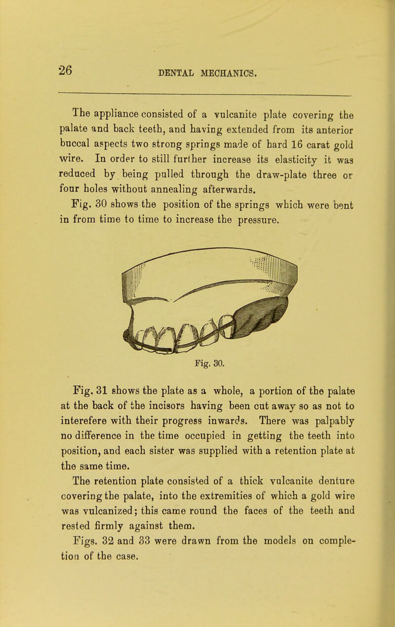 The appliance consisted of a vulcanite plate covering the palate and back teeth, and having extended from its anterior buccal aspects two strong springs made of hard 16 carat gold wire. In order to still further increase its elasticity it was reduced by being palled through the draw-plate three or four holes without annealing afterwards. Fig. 30 shows the position of the springs which were bont in from time to time to increase the pressure. Fig. 30. Fig. 31 shows the plate as a whole, a portion of the palate at the back of the incisors having been cut away so as not to interefere with their progress inwards. There was palpably no difference in the time occupied in getting the teeth into position, and each sister was supplied with a retention plate at the same time. The retention plate consisted of a thick vulcanite denture covering the palate, into the extremities of which a gold wire was vulcanized; this came round the faces of the teeth and rested firmly against them. Figs. 32 and 33 were drawn from the models on comple- tion of the case.