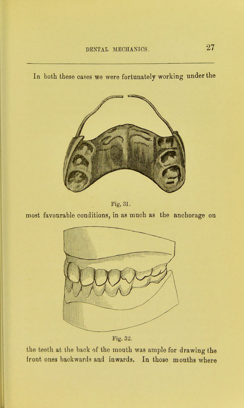 la both these cases we were fortunately working under the Fig, 31. most favourable conditions, in as much as the anchorage on Fig. 32. the teeth at the back of the mouth was ample for drawing the front ones backwards and inwards. In those mouths where