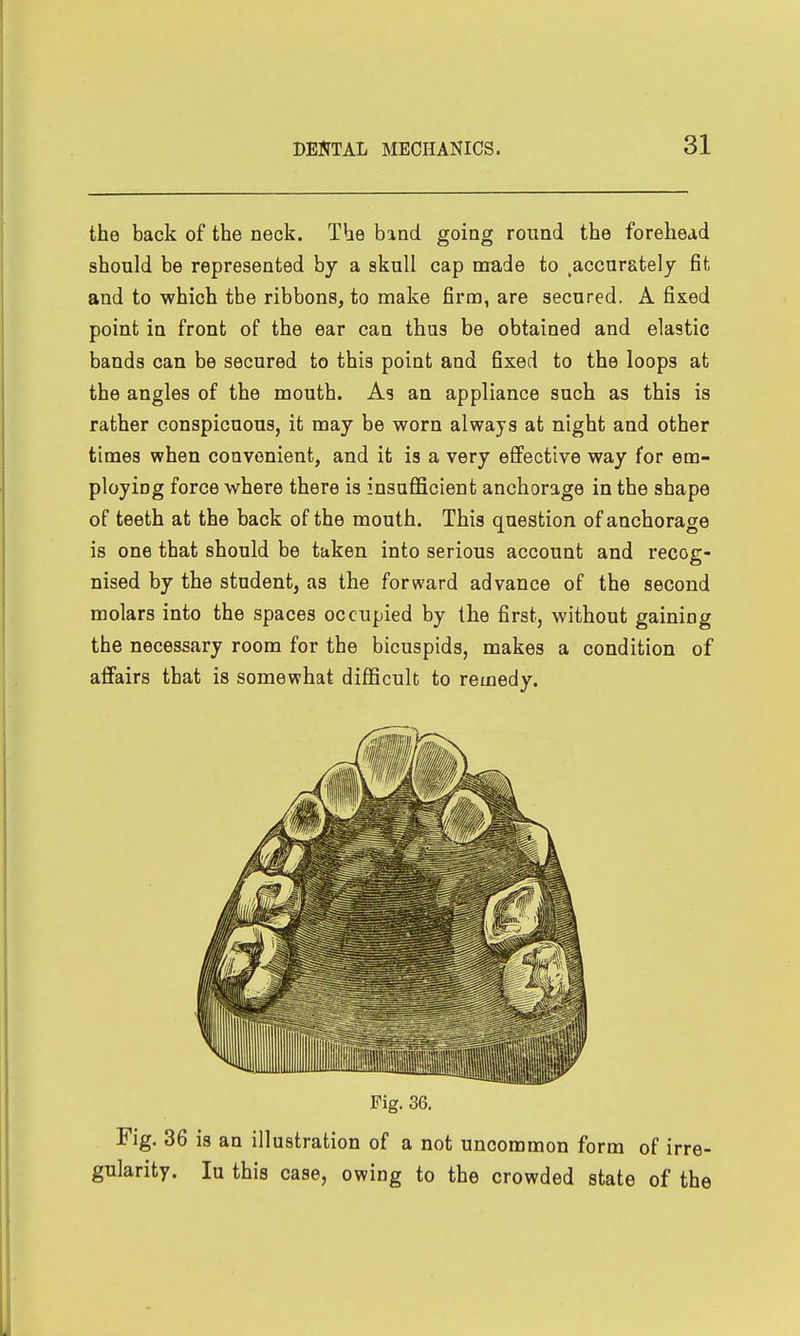 the back of the neck. The band going round the forehead should be represented by a skull cap made to ^accurately fit and to which the ribbons, to make firm, are secured. A fixed point in front of the ear can thus be obtained and elastic bands can be secured to this point and fixed to the loops at the angles of the mouth. As an appliance such as this is rather conspicuous, it may be worn always at night and other times when convenient, and it is a very eflfective way for em- ploying force where there is insufficient anchorage in the shape of teeth at the back of the mouth. This question of anchorage is one that should be taken into serious account and recog- nised by the student, as the forward advance of the second molars into the spaces occupied by the first, without gaining the necessary room for the bicuspids, makes a condition of affairs that is somewhat difficult to remedy. Fig. 36. Fig. 36 is an illustration of a not uncommon form of irre- gularity, lu this case, owing to the crowded state of the