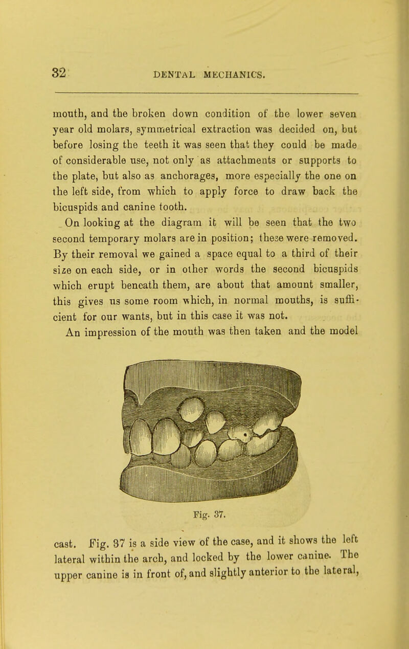 82 month, and the broken down condition of the lower seven year old molars, symmetrical extraction was decided on, but before losing the teeth it was seen that they could be made of considerable use, not only as attachments or supports to the plate, but also as anchorages, more especially the one on the left side, from which to apply force to draw back the bicuspids and canine tooth. On looking at the diagram it will be seen that the two second temporary molars are in position; these were removed. By their removal we gained a space equal to a third of their size on each side, or in other words the second bicuspids which erupt beneath them, are about that amount smaller, this gives us some room which, in normal mouths, is suffi- cient for our wants, but in this case it was not. An impression of the mouth was then taken and the model cast. Fig. 37 is a side view of the case, and it shows the left; lateral within the arch, and locked by the lower canine. The upper canine is in front of, and slightly anterior to the lateral.
