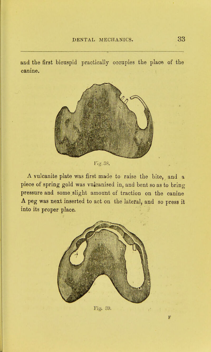 and the first bicuspid practically occupies the place of the canine. ! Fig. 38. A vulcanite plate was first naade to raise the bite, and a piece of spring gold was vulcanised in, and bent so as to bring pressure and some slight amount of traction on the canine A peg was next inserted to act on the lateral, and so press it into its proper place. Fig, 39. F