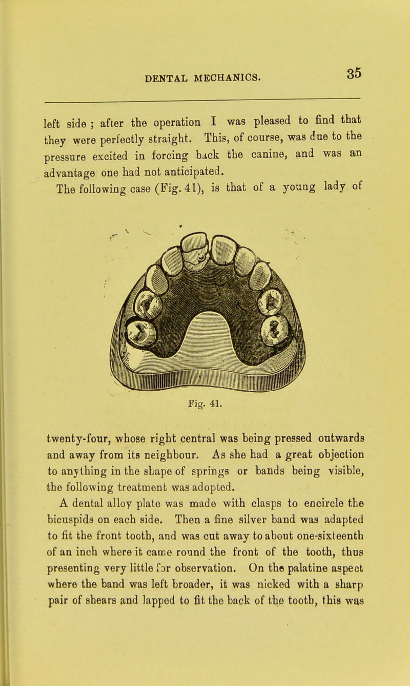 left side ; after the operation I was pleased to find that they were perfectly straight. This, of course, was due to the pressure excited in forcing back the canine, and was an advantage one had not anticipated. The following case (Fig. 41), is that of a young lady of Fig. 41. twenty-four, whose right central was being pressed outwards and away from its neighbour. As she had a great objection to anything in the shape of springs or bands being visible, the following treatment was adopted. A dental alloy plate was made with clasps to encircle the bicuspids on each side. Then a fine silver band was adapted to fit the front tooth, and was cut away to about one-sixteenth of an inch where it came round the front of the tooth, thus presenting very little for observation. On the palatine aspect where the band was left broader, it was nicked with a sharp pair of shears and lapped to fit the back of the tooth, this was