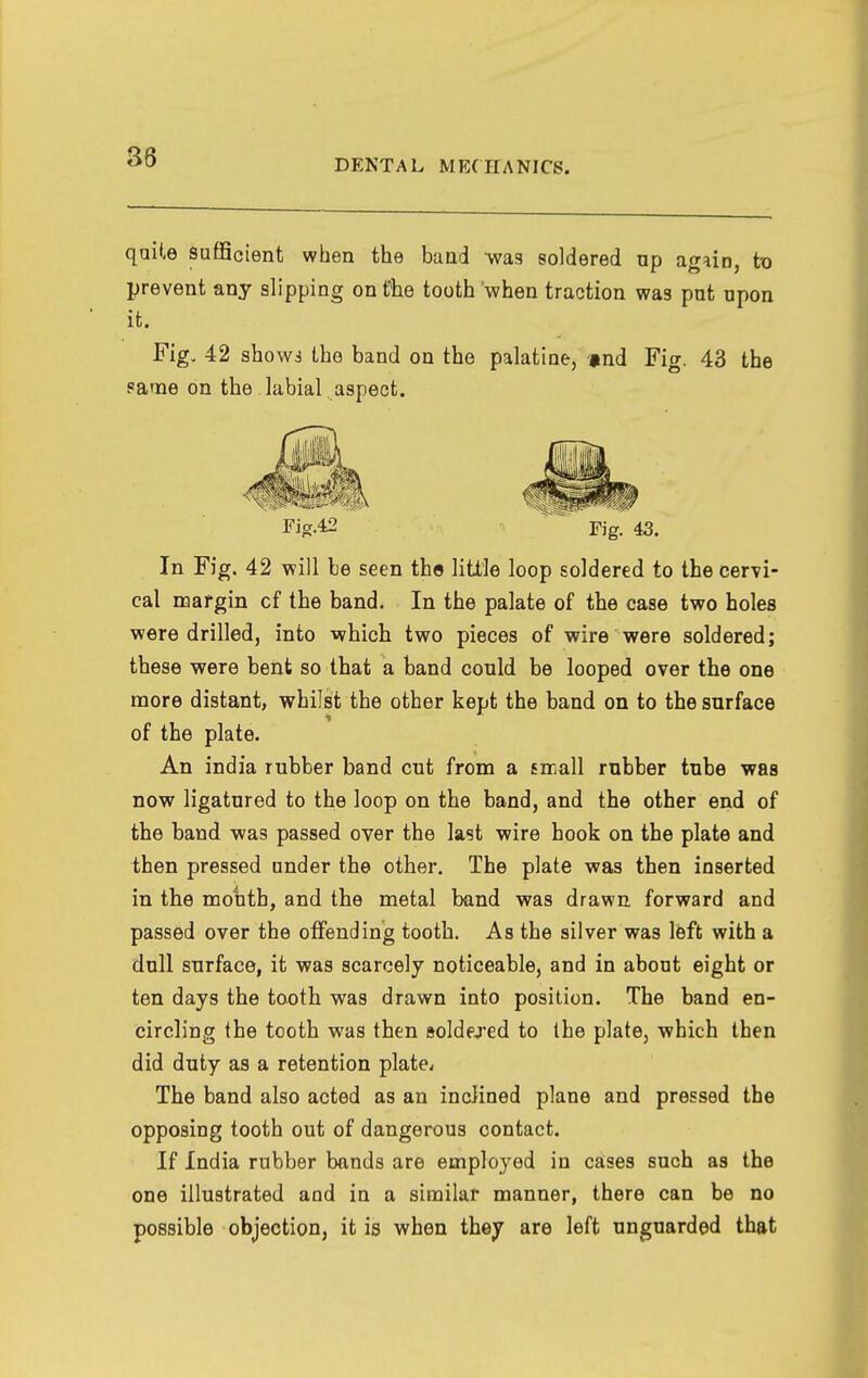 DENTAL MECHANICS. qaite Sufficient when the band -was soldered up again, to prevent any slipping on the tooth when traction was put upon it. Fig. 42 showj the band on the palatine, jind Fig. 43 the fame on the labial aspect. Fis.42 Fig. 43. In Fig. 42 will be seen the little loop soldered to the cervi- cal noargin of the band. In the palate of the case two holes were drilled, into which two pieces of wire were soldered; these were bent so that a band could be looped over the one more distant, whilst the other kept the band on to the surface of the plate. An india rubber band cut from a small rubber tube was now ligatured to the loop on the band, and the other end of the band was passed over the last wire hook on the plate and then pressed under the other. The plate was then inserted in the mouth, and the metal band was drawn forward and passed over the offending tooth. As the silver was left with a dull surface, it was scarcely noticeable, and in about eight or ten days the tooth was drawn into position. The band en- circling the tooth was then soldej-ed to the plate, which then did duty as a retention plate* The band also acted as an inclined plane and pressed the opposing tooth out of dangerous contact. If India rubber bands are employed in cases such as the one illustrated and in a similar manner, there can be no possible objection, it is when they are left unguarded that