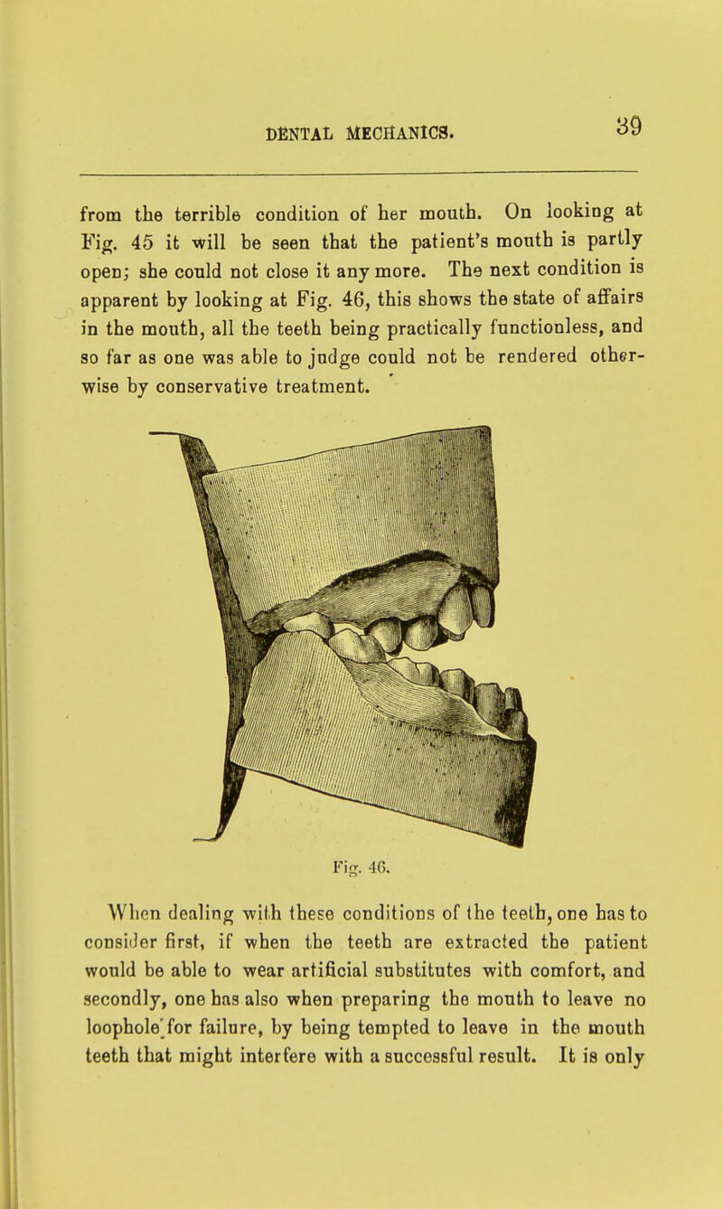 from the terrible condition of her naouth. On looking at Fior. 45 it will be seen that the patient's mouth is partly open; she could not close it any more. The next condition is apparent by looking at Fig. 46, this shows the state of affairs in the mouth, all the teeth being practically functionless, and so far as one was able to judge could not be rendered other- wise by conservative treatment. Fig. 46. When dealing with these conditions of the teeth, one has to consider first, if when the teeth are extracted the patient would be able to wear artificial substitutes with comfort, and secondly, one has also when preparing the mouth to leave no loophole'for failure, by being tempted to leave in the mouth teeth that might interfere with a successful result. It is only