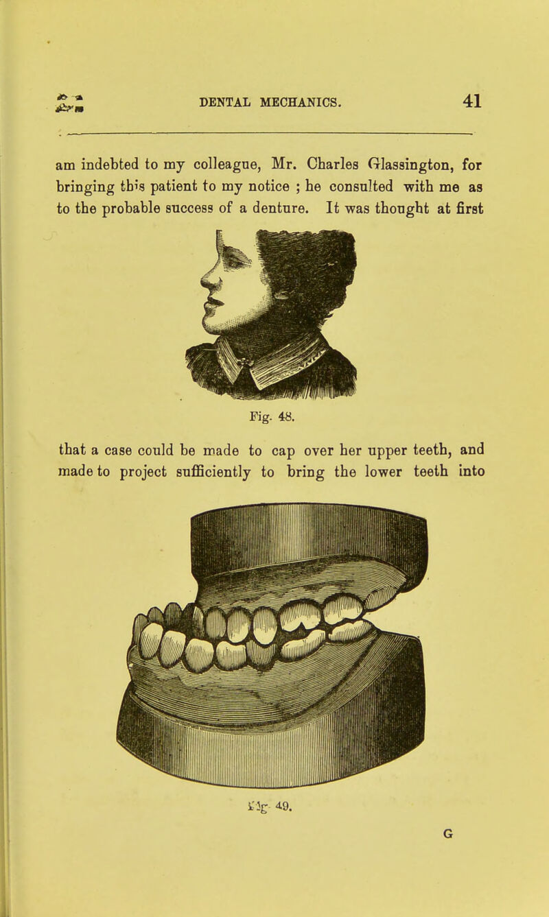 am indebted to my colleague, Mr. Charles Glassington, for bringing this patient to my notice ; he consulted with me as to the probable success of a denture. It was thought at first Fig. 48. that a case could be made to cap over her upper teeth, and made to project suflSciently to bring the lower teeth into t Jg; 49. G