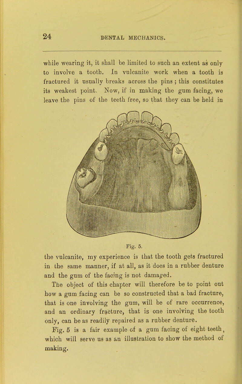 while wearing it, it shall be limited to such an extent as only to involve a tooth. In vulcanite work when a tooth is fractured it usually breaks across the pins ; this constitutes its weakest point. Now, if in making the gum facing, we leave the pins of the teeth free, so that they can be held in Fig. 5. the vulcanite, ray experience is that the tooth gets fractured in the same manner, if at all, as it does in a rubber denture and the gum of the facing is not damaged. The object of this chapter will therefore be to point out how a gum facing can be so constructed that a bad fracture, that is one involving the gum, will be of rare occurrence, and an ordinary fracture, that is one involving the tooth only, can be as readily repaired as a rubber denture. Fig. 5 is a fair example of a gum facing of eight teeth, which will serve us as an illustration to show the method of making.