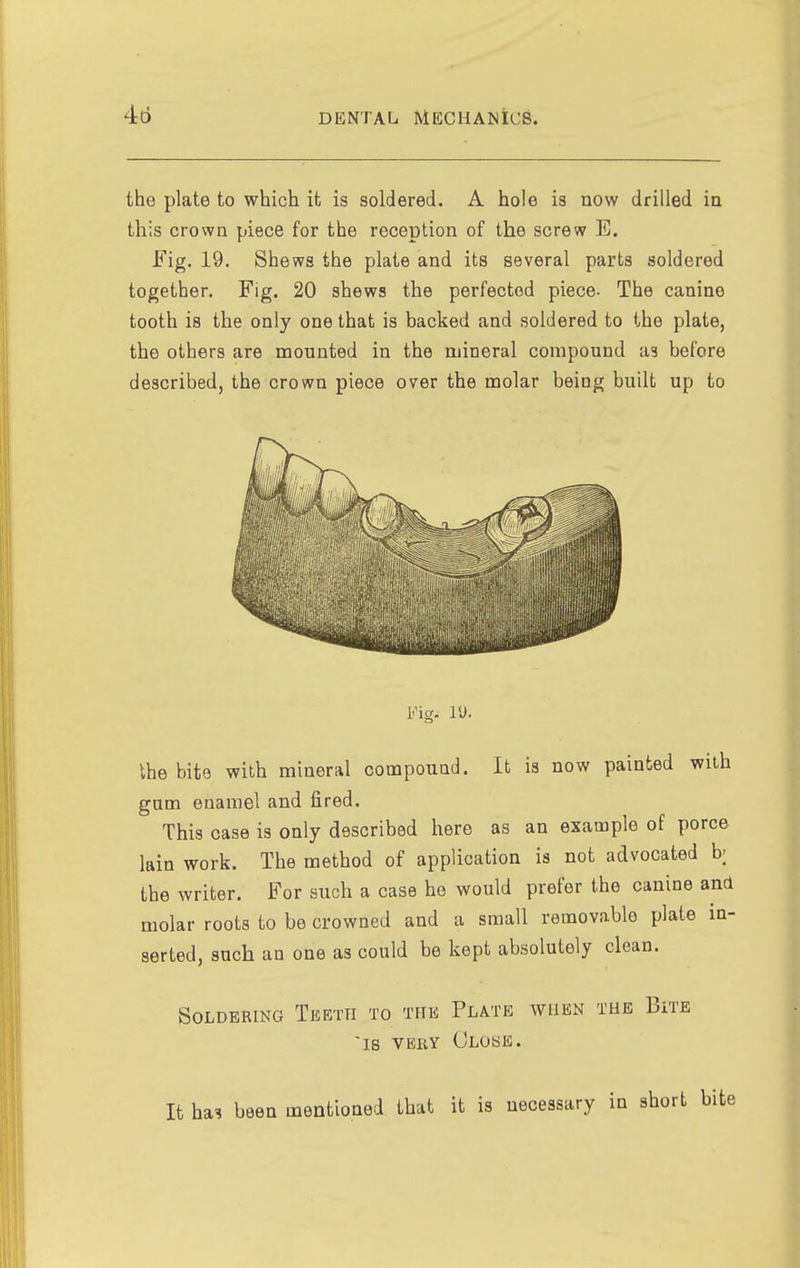 the plate to which it is soldered. A hole is now drilled in this crown piece for the reception of the screw E. Fig. 19. Shews the plate and its several parts soldered together. Fig. 20 shews the perfected piece- The canine tooth is the only one that is backed and soldered to the plate, the others are mounted in the mineral compound as before described, the crown piece over the molar being built up to Fig. I'J. Ihe bite with mineral compound. It is now painted with gum enamel and fired. This case is only described here as an example of porce lain work. The method of application is not advocated b; the writer. For such a case he would prefer the canine and molar roots to be crowned and a small removable plate in- serted, such an one as could be kept absolutely clean. Soldering Teetti to the Plate when the Bite IS VERY Close. It ha^ been mentioned that it is necessary in short bite