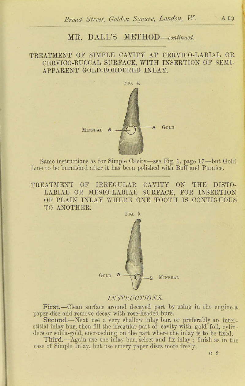 MR. BALL'S METHOD—fo^i^mm/. TREATMENT OF SIMPLE CAVITY AT CEEVICO-LABIAL OR CERYICO-BUCCAL SURFACE, WITH INSERTION OF SEMI- APPARENT GOLD-BORDERED INLAY. Fig. 4, Mineral 8 Gold Same instructions as for Simple Cavity—see Fig. 1, page 17—but Gold Line to be burnished after it has been polished with Buff and Pumice. TREATMENT OF IRREGULAR CAVITY ON THE DISTO- LABIAL OR MESIO-LABIAL SURFACE, FOR INSERTION OF PLAIN INLAY WHERE ONE TOOTH IS CONTIGUOUS TO ANOTHER. Fig. 5. Gold A ^1^1 mujeral INSTRUCTIONS. First.—Clean surface around decayed part by using in the engine a paper disc and remove decay with rose-headed burs. Second.—Next use a very shallow inlay bur, or preferably an inter- stitial inlay bur, then fill the irregular part of cavity with gold foil, cylin- ders or solila-gold, encroaching on the part where the inlay is to be jfix'ed. Third.—Again use the inlay bur, select and fix inlay ; finisli as in the case of Simple Inlay, but use emery paper discs more freely. 0 2