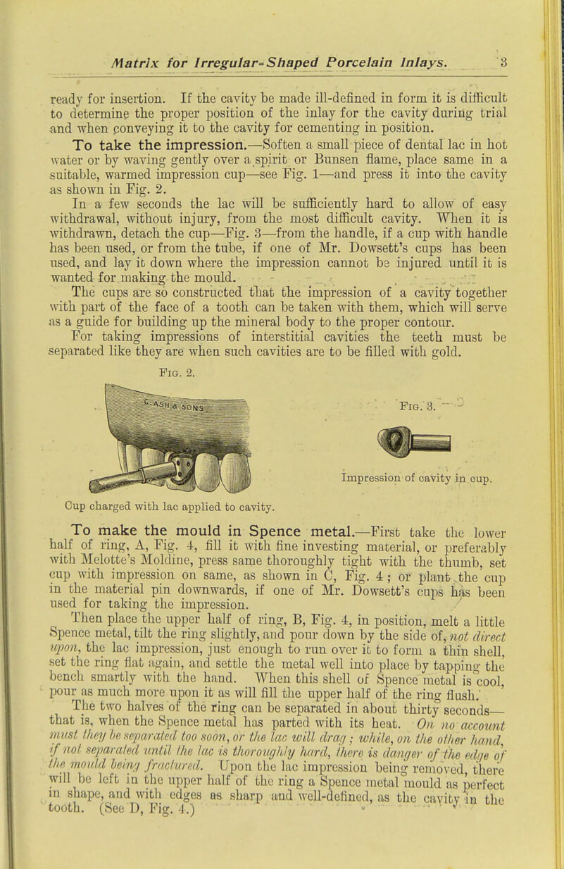 ready for insertion. If the cavity be made ill-defined in form it is difficult to determine the proper position of the inlay for the cavity during trial and when ponveying it to the cavity for cementing in position. To take the impression.—Soften a small piece of dental lac in hot water or by waving gently over a spirit or Bunsen flame, place same in a suitable, warmed impression cup—see Fig. 1—and press it into the cavity a,s shown in Fig. 2. In a few seconds the lac will be sufficiently hard to allow of easy withdrawal, without injury, from the most difficult cavity. When it is withdrawn, detach the cup—Fig. 3—from the handle, if a cup with handle has been used, or from the tube, if one of Mr. Dowsett's cups has been used, and lay it down where the impression cannot be injured until it is wanted for making the mould. - , The cups are so constructed that the impression of a cavitytogether Nvith part of the face of a tooth can be taken with them, which will serve as a guide for building up the mineral body to the proper contour. For taking impressions of interstitial cavities the teeth must be separated like they are when such cavities are to be filled with gold. Fig. 2. Cup charged with lac applied to cavity. To make the mould in Spence metal.—First take the lower half of ring, A, Fig. 4, fill it with fine investing material, or preferably with Melotte's Moldiue, press same thoroughly tight with the thumb, set cup with impression on same, as shown in C, Fig. 4; or plant.the cup in the material pin downwards, if one of Mr. Dowsett's caps has been used for taking the impression. Then place the upper half of ring, B, Fig. 4, in position, melt a little Spence metal, tilt the ring slightly, and pour down by the side of, not direct upon, the lac impression, just enough to run over it to form a thin shell, set the ring flat again, and settle the metal well into place by tapping the bench smartly with the hand. When this shell of Spence metal is cool, pour as much more upon it as will fill the upper half of the ring flush.' Tlie two halves of the ring can be separated in about thirty seconds that is, when the Spence metal has parted with its heat. On no account must they he fieimrated too soon, or the lac ivill draq; ivhile, on the other hand if not separated until the lac is thoroitgkly hard, there is danger of ihe edm of the mould heing fractured. Upon the lac impression being removed, there will be left in the upper half of the ring a Spence metal mould as pci-fect m shape, and witli edges as sharp and well-defined, as the cavity in the tooth. (See D, Fig. 4.) - ^'