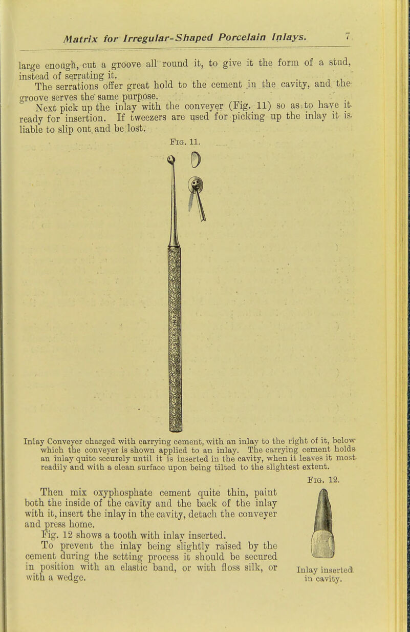 large enough, cut a groove all round it, to give it the form of a stud, instead of serrating it. • j i The serrations offer great hold to the cement in the cavity, and the- o-roove serves the same purpose. Next pick up the inlay with the conveyer (Fig. 11) so as to have it ready for insertion. If tweezers are used for picking up the inlay it is. liable to slip out. and be lost. Fig. 11. Inlay Conveyer charged with carrying cement, with an inlay to the right of it, below- which the conveyer is shown applied to an inlay. The carrying cement holds- an inlay quite securely until it is inserted iu the cavity, when it leaves it most readily and with a clean surface upon being tilted to the slightest extent. Fig. 12. Then mix oxyphosphate cement quite thin, paint both the inside of the cavity and the back of the inlay with it, insert the inlay in the cavity, detach the conveyer and press home. Fig. 12 shows a tooth with inlay inserted. To prevent the inlay being slightly raised by the cement during the setting process it should be secured in position with an elastic band, or with floss silk, or with a wedge. Inlay inserted in cavity.
