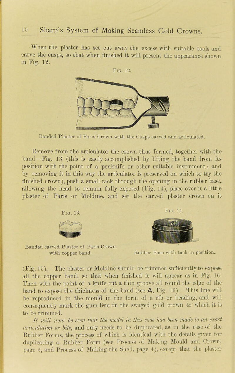 When the plaster has set cut away the excess with suitable tools and carve the cusps, so that when finished it Avill present the appearance shown in Fig. 12. Fig. 12. Banded Plaster of Paris Crown with the Cusps carved and articulated. Eemove from the articulator the cro\ra thus formed, together with the- band—Fig. 13 (this is easily accomplished by lifting the band from its position with the point of a penknife or other suitable instrument; and by removing it in this way the articulator is preserved on which to try the finished crown), push a small tack through the opening in the rubber base^ allowing the head to remain fully exposed (Fig. 14), place over it a little plaster of Paris or Moldine, and set the carved plaster crown on it Banded carved Plaster of Paris Crown with copper band. Rubber Base with tack in position.- (Fig. 15). The plaster or Moldine should be trimmed sufficiently to expose all the copper band, so that when finished it will appear as in Fig. 16. Then with tlie point of a knife cut a tliin groove all round the edge of the band to expose the thickness of the band (see A, Fig. IC). This line will be reproduced in the mould in the form of a rib or beading, and will consequently mark the gum line on the swaged gold crown to which it is to be trimmed. It ivill noiv he seen that the model in this case has been made to an exact articulation or bite, and only needs to be duplicated, as in the case of the Kubber Forms, the process of which is identical with the details given for duplicating a Rubber Form (see Process of Making Mould and Crown, page 3, and i.^rocess of Making the Sliell, page 4), except that the plaster