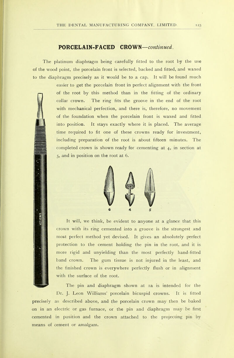 PORCELAIN-FACED CROVJIH—continued The platinum diaphragm being carefully fitted to the root by the use of the wood point, the porcelain front is selected, backed and fitted, and waxed to the diaphragm precisely as it would be to a cap. It will be found much easier to get the porcelain front in perfect alignment with the front of the root by this method than in the fitting of the ordinary collar crown. The ring fits the groove in the end of the root with mechanical perfection, and there is, therefore, no movement of the foundation when the porcelain front is waxed and fitted into position. It stays exactly where it is placed. The average time required to fit one of these crowns ready for investment, including preparation of the root is about fifteen minutes. The completed crown is shown ready for cementing at 4, in section at 5, and in position on the root at 6. ■ It will, we think, be evident to anyone at a glance that this crown with its ring cemented into a groove is the strongest and most perfect method yet devised. It gives an absolutely pnrfect protection to the cement holding the pin in the root, and it is more rigid and unyielding than the most perfectly hand-fitted band crown. The gum tissue is not injured in the least, and the finished crown is everywhere perfectly flush or in alignment with the surface of the root. The pin and diaphragm shown at la is intended for the Dr. J. Leon Williams' porcelain bicuspid crowns. It is fitted precisely as described above, and the porcelain crown may then be baked on in an electric or gas furnace, or the pin and diaphragm may be first cemented in position and the crown attached to the projecting pin by means of cement or amalgam.