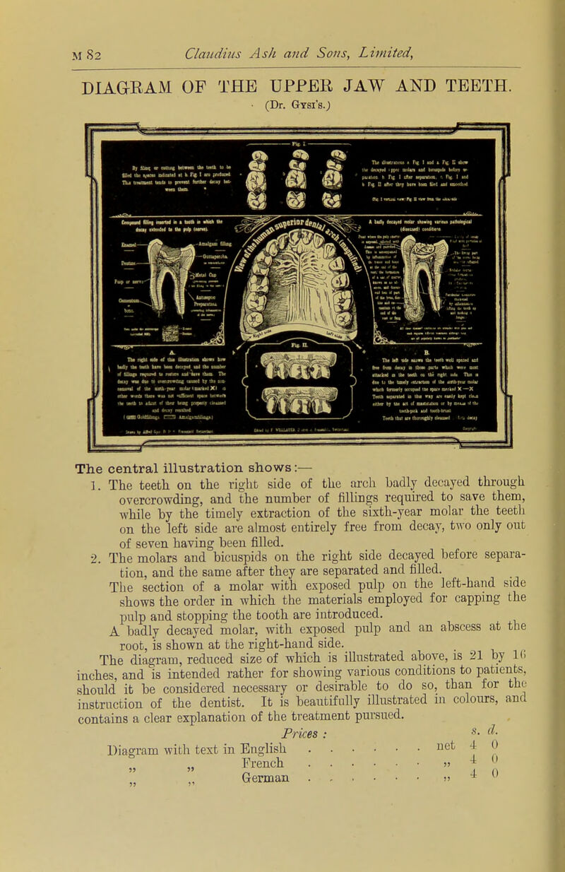 DIAGRAM OF THE UPPER JAW AND TEETH. • (Dr. Gysi's.J 0 Bf 'I'mfF or cutkiig bMwean the u he filled ihu mduatei it b Tif I m pniiosed Tlu UMtment lull la pwtnl farther dr.if bM- Tbr ill n*: i'. , i Fig I » fit | u. w lh| J««n*i ipfi nioJtrt aad bifufpidi bofon w (uj4l<aa b He I tSva HptntiEn. Fij I ud t Fi$ □ *ft»r ih-j btn hwn filrl *n<I tmiwlh^ 3^ The central illustration shows:— 1. The teeth on the right side of the arch badly decayed through overcrowding, and the number of fillings required to save them, while by the timely extraction of the sixth-year molar the teeth on the left side are almost entirely free from decay, two only out of seven having been filled. 2. The molars and bicuspids on the right side decayed before separa- tion, and the same after they are separated and filled. The section of a molar with exposed pulp on the left-hand side shows the order in which the materials employed for capping the pulp and stopping the tooth are introduced. A badly decayed molar, with exposed pulp and an abscess at the root, is shown at the right-hand side. The diagram, reduced size of which is illustrated above, is 21 by 16 inches, and is intended rather for showing various conditions to patients, should it be considered necessary or desirable to do so, than for the instruction of the dentist. It is beautifully illustrated m colours, and contains a clear explanation of the treatment pursued. Prices : s- d- Diagram with text in English net -I o „ „ French » 4 11 German » » 0