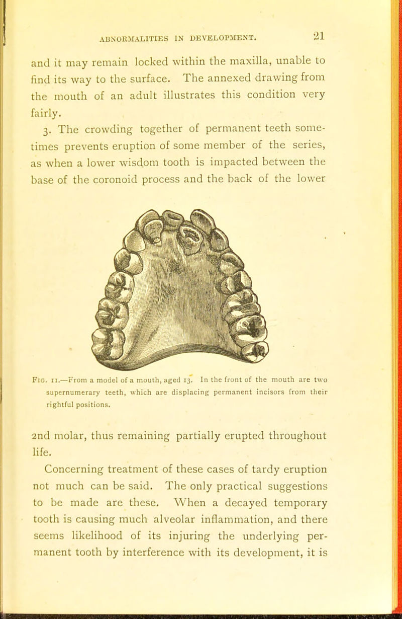 and it may remain locked within the maxilla, unable to find its way to the surface. The annexed drawing from the mouth of an adult illustrates this condition very fairly. 3. The crowding together of permanent teeth some- times prevents eruption of some member of the series, as when a lower wisdom tooth is impacted between the base of the coronoid process and the back of the lower Fig. II.—From a model of a mouth, aged 13. In the front of the mouth are two supernumerary teeth, which are displacing permanent incisors from their rightful positions. 2nd molar, thus remaining partially erupted throughout life. Concerning treatment of these cases of tardy eruption not much can be said. The only practical suggestions to be made are these. When a decayed temporary tooth is causing much alveolar inflammation, and there seems likelihood of its injuring the underlying per- manent tooth by interference with its development, it is