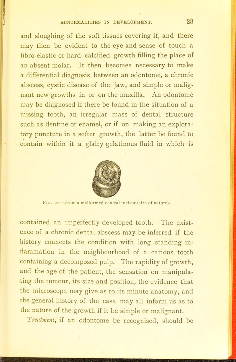 and sloughing of the soft tissues covering it, and there may then be evident to the eye and sense of touch a fibro-elastic or hard calcified growth filling the place of an absent molar. It then becomes necessary to make a differential diagnosis between an odontome, a chronic abscess, cystic disease of the jaw, and simple or malig- nant new growths in or on the maxilla. An odontome may be diagnosed if there be found in the situation of a missing tooth, an irregular mass of dental structure such as dentine or enamel, or if on making an explora- tory puncture in a softer growth, the latter be found to contain within it a glairy gelatinous fluid in which is Fig. 12.—From a malformed central incisor (size of nature). contained an imperfectly developed tooth. The exist- ence of a chronic dental abscess may be inferred if the history connects the condition with long standing in- flammation in the neighbourhood of a carious tooth containing a decomposed pulp. The rapidity of growth, and the age of the patient, the sensation on manipula- ting the tumour, its size and position, the evidence that the microscope may give as to its minute anatomy, and the general history of the case may all inform us as to the nature of the growth if it be simple or malignant. Treatment, if an odontome be recognised, should be