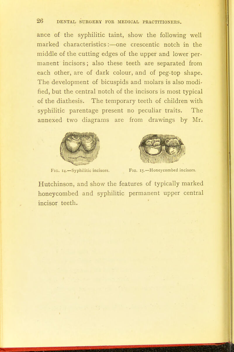 ance of the syphilitic taint, show the following well marked characteristics:—one crescentic notch in the middle of the cutting edges of the upper and lower per- manent incisors; also these teeth are separated from each other, are of dark colour, and of peg-top shape. The development of bicuspids and molars is also modi- fied, but the central notch of the incisors is most typical of the diathesis. The temporary teeth of children with syphilitic parentage present no peculiar traits. The annexed two diagrams are from drawings by Mr. Fig. 14.—Syphilitic incisors. Fig. 15.—Honeycombed incisors. Hutchinson, and show the features of typically marked honeycombed and syphilitic permanent upper central incisor teeth.