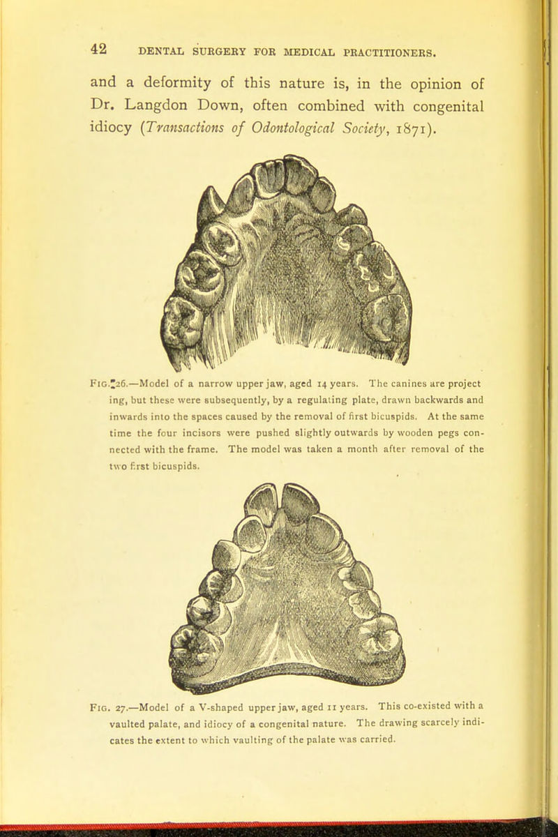 and a deformity of this nature is, in the opinion of Dr. Langdon Down, often combined with congenital idiocy (Transactions of Odontological Society, 1S71). Fig 36.—Model of a narrow upper jaw, aged 14 years. The canines are project ing, but these were subsequently, by a regulating plate, drawn backwards and inwards into the spaces caused by the removal of first bicuspids. At the same time the four incisors were pushed slightly outwards by wooden pegs con- nected with the frame. The model was taken a month after removal of the two first bicuspids. Fig. 27.—Model of a V-shaped upper jaw, aged 11 years. This co-existed with a vaulted palate, and idiocy of a congenital nature. The drawing scarcely indi- cates the extent to which vaulting of the palate was carried.