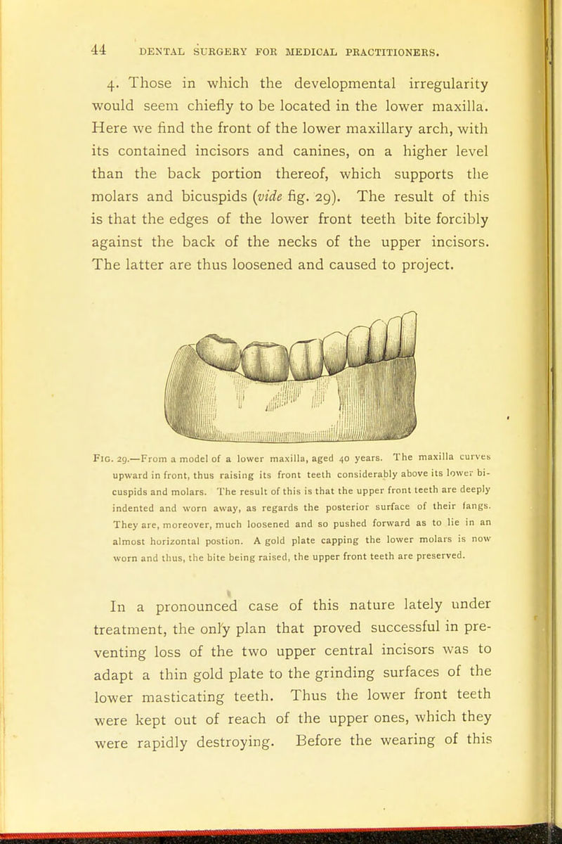 4. Those in which the developmental irregularity would seem chiefly to be located in the lower maxilla. Here we find the front of the lower maxillary arch, with its contained incisors and canines, on a higher level than the back portion thereof, which supports the molars and bicuspids (vide fig. 29). The result of this is that the edges of the lower front teeth bite forcibly against the back of the necks of the upper incisors. The latter are thus loosened and caused to project. Fig. 29.—From a model of a lower maxilla, aged 40 years. The maxilla curves upward in front, thus raising its front teeth considerably above its lower bi- cuspids and molars. The result of this is that the upper front teeth are deeply indented and worn away, as regards the posterior surface of their fangs. They are, moreover, much loosened and so pushed forward as to lie in an almost horizontal postion. A gold plate capping the lower molars is now worn and thus, the bite being raised, the upper front teeth are preserved. In a pronounced case of this nature lately under treatment, the only plan that proved successful in pre- venting loss of the two upper central incisors was to adapt a thin gold plate to the grinding surfaces of the lower masticating teeth. Thus the lower front teeth were kept out of reach of the upper ones, which they were rapidly destroying. Before the wearing of this