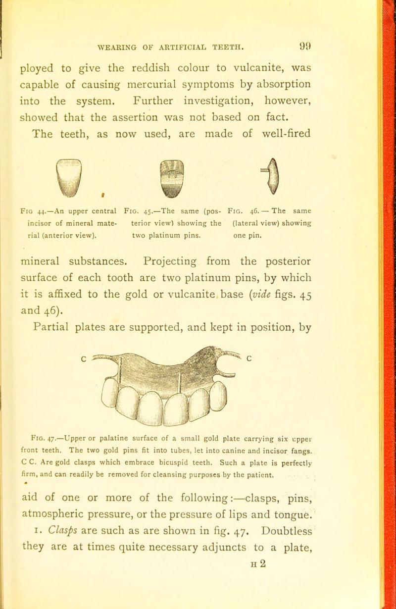 ployed to give the reddish colour to vulcanite, was capable of causing mercurial symptoms by absorption into the system. Further investigation, however, showed that the assertion was not based on fact. The teeth, as now used, are made of well-fired Fig 44.—An upper central Fig. 45.—The same (pos- Fig. 46. — The same incisor of mineral mate- terior view) showing the (lateral view) showing rial (anterior view). two platinum pins. one pin. mineral substances. Projecting from the posterior surface of each tooth are two platinum pins, by which it is affixed to the gold or vulcanite base {vide figs. 45 and 46). Partial plates are supported, and kept in position, by Fig. 47.—Upper or palatine surface of a small gold plate carrying six upper front teeth. The two gold pins fit into tubes, let into canine and incisor fangs. C C. Are gold clasps which embrace bicuspid teeth. Such a plate is perfectly firm, and can readily be removed for cleansing purposes by the patient. aid of one or more of the following:—clasps, pins, atmospheric pressure, or the pressure of lips and tongue. 1. Clasps are such as are shown in fig. 47. Doubtless they are at times quite necessary adjuncts to a plate, h2